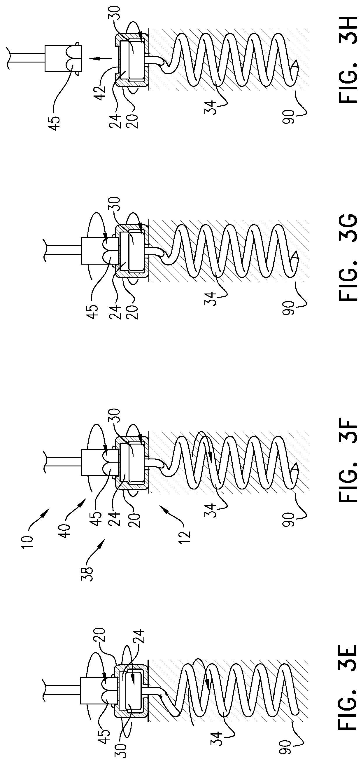 Patent US12396718 Figure 6 – Self-stopping tissue anchors