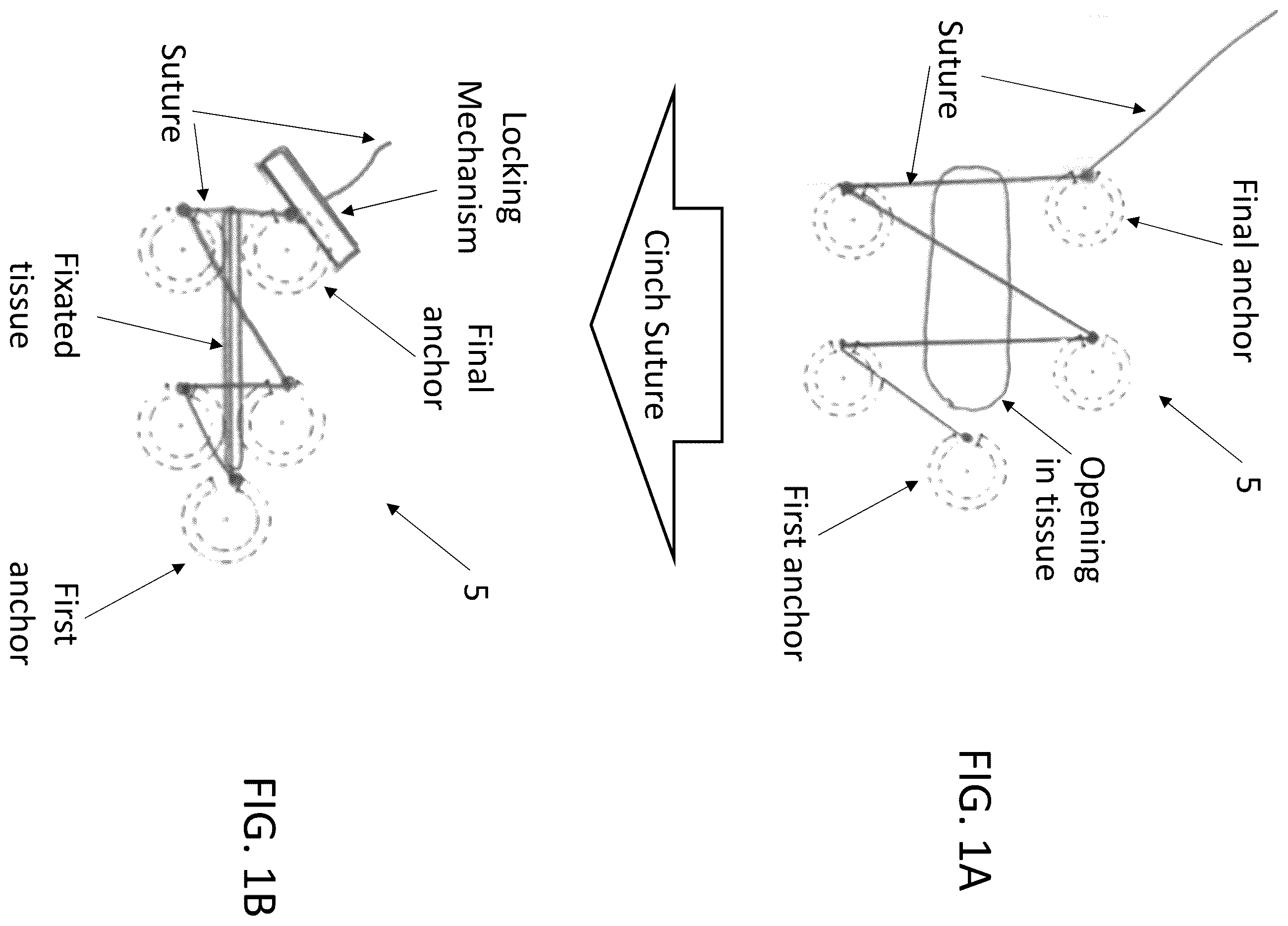 Patent US12396719 Figure 1 – Soft tissue fixation system