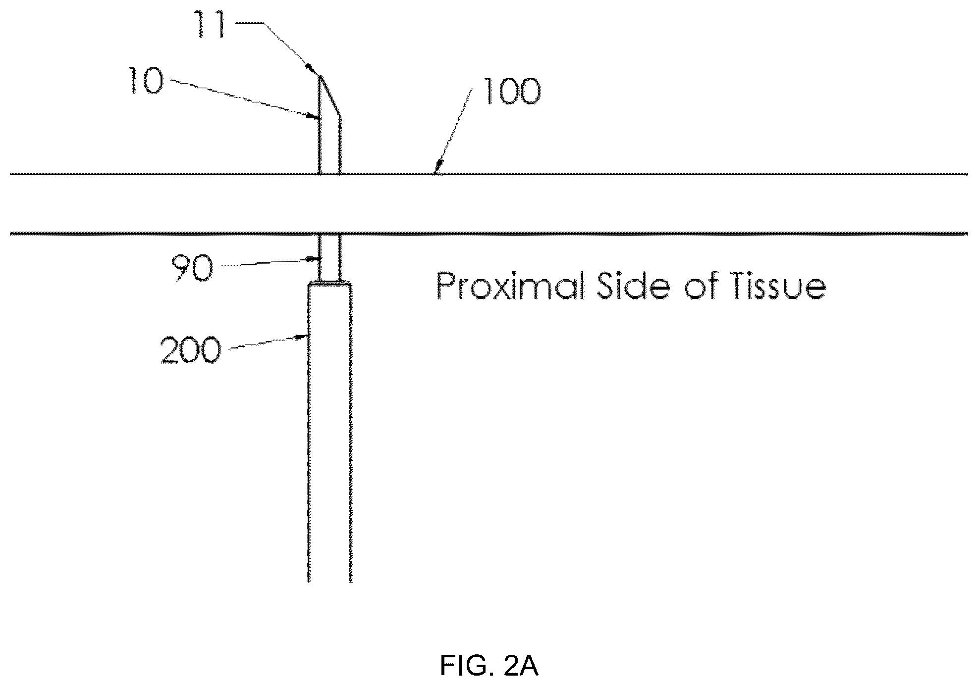 Patent US12396719 Figure 2 – Soft tissue fixation system