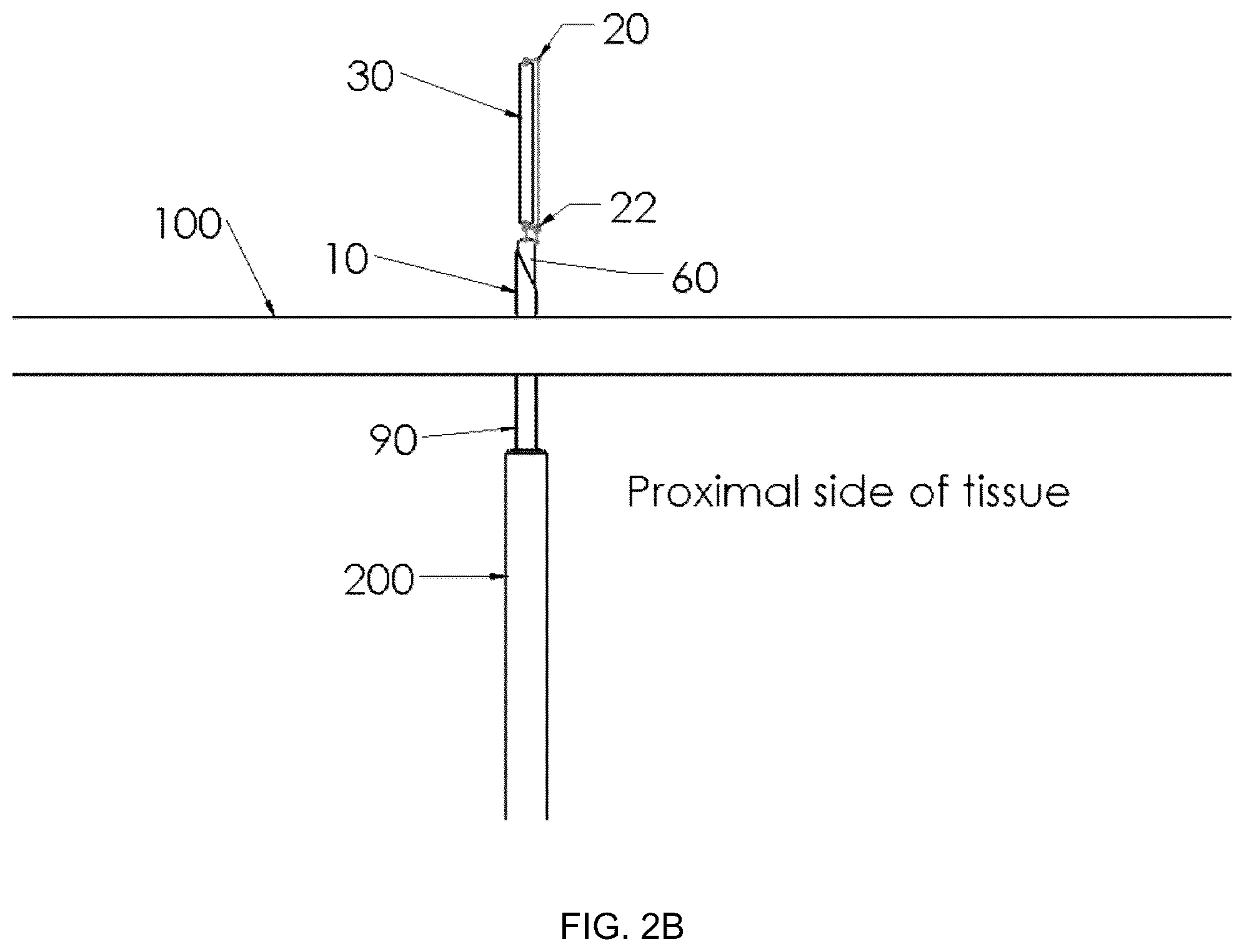 Patent US12396719 Figure 3 – Soft tissue fixation system