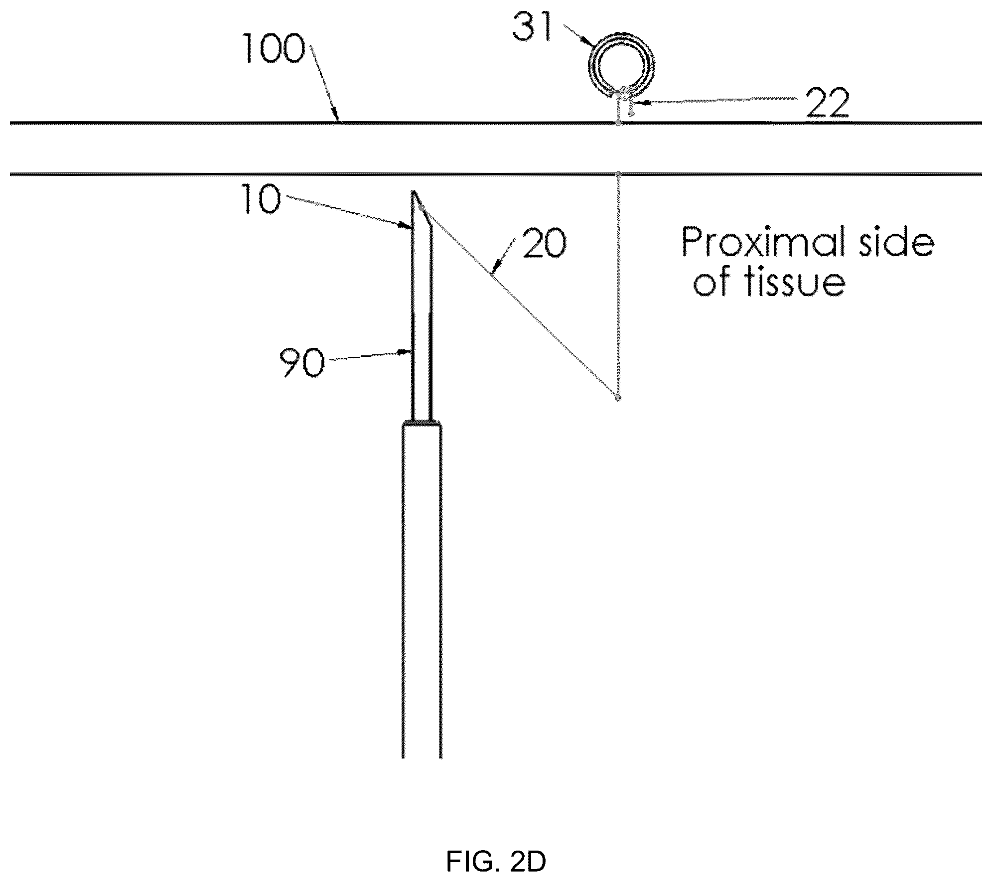Patent US12396719 Figure 5 – Soft tissue fixation system