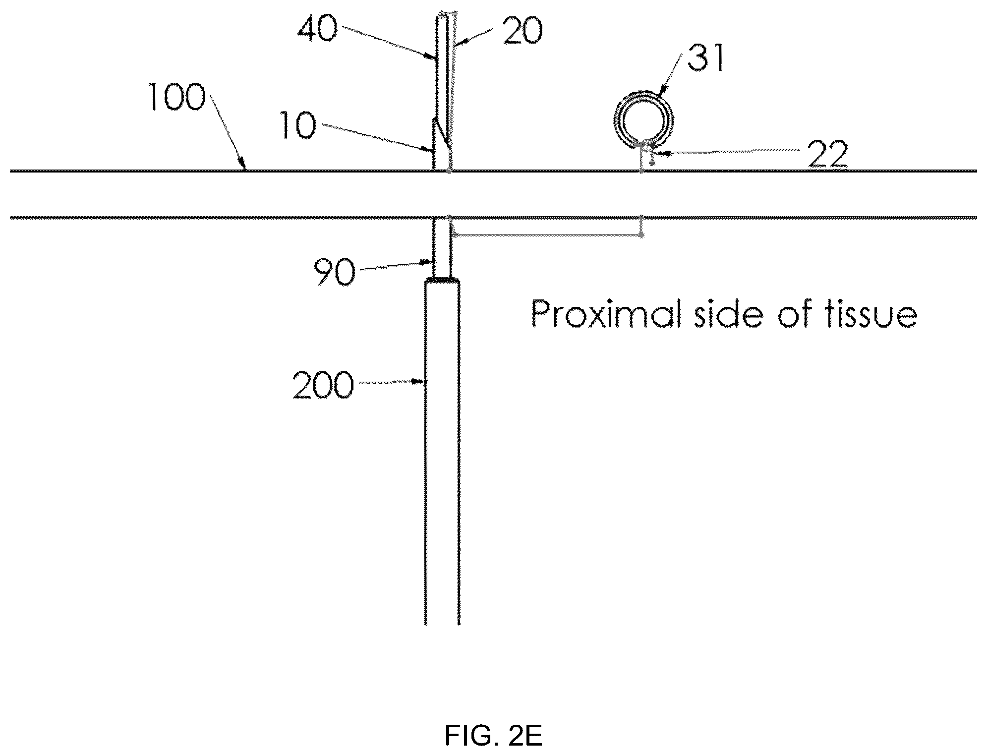 Patent US12396719 Figure 6 – Soft tissue fixation system