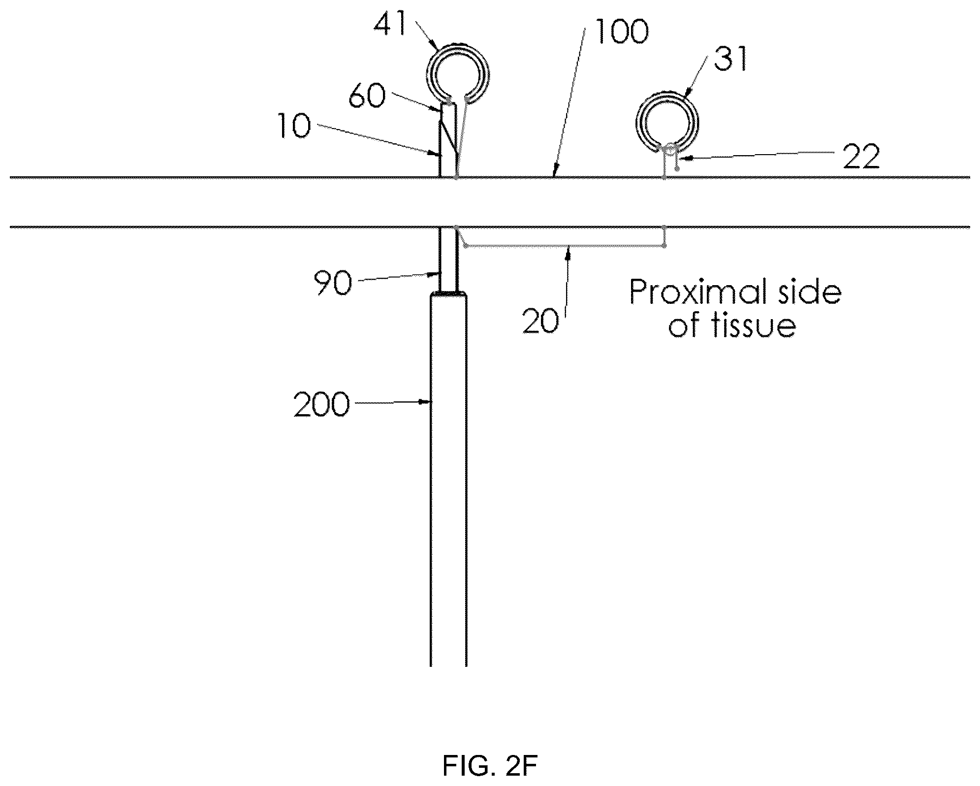 Patent US12396719 Figure 7 – Soft tissue fixation system