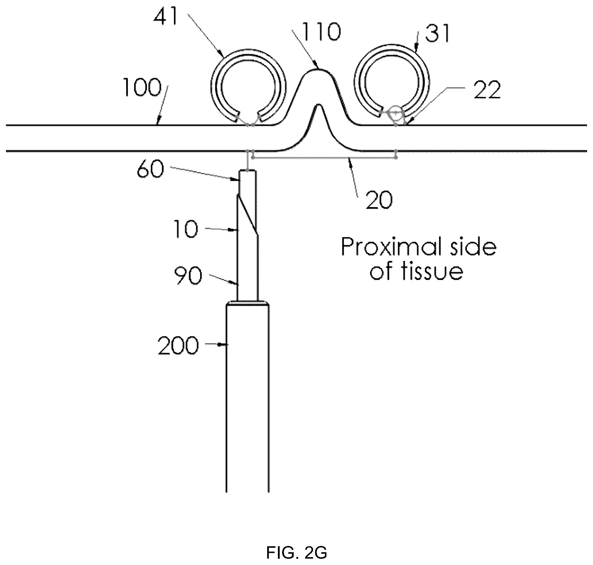 Patent US12396719 Figure 8 – Soft tissue fixation system