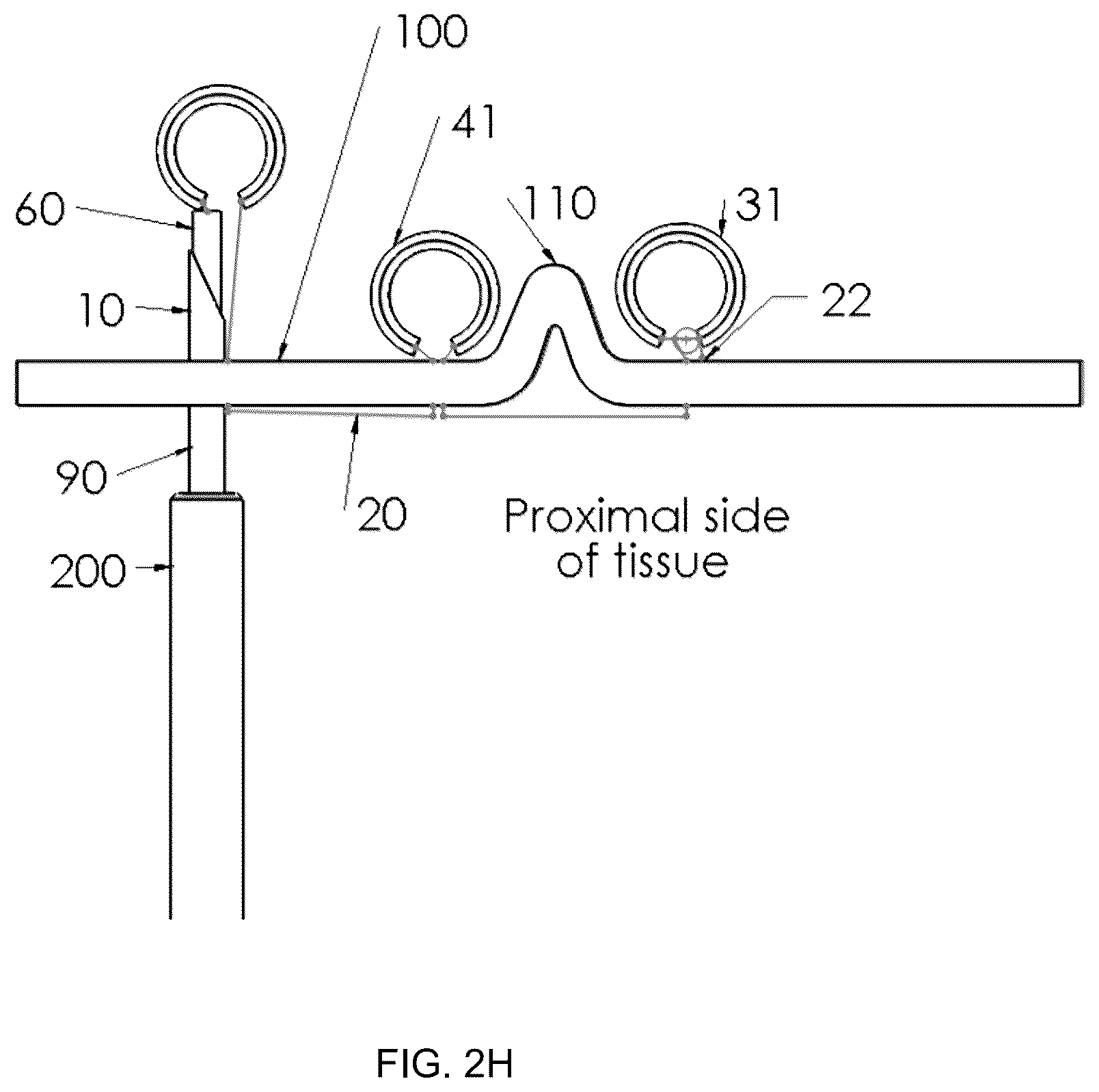Patent US12396719 Figure 9 – Soft tissue fixation system