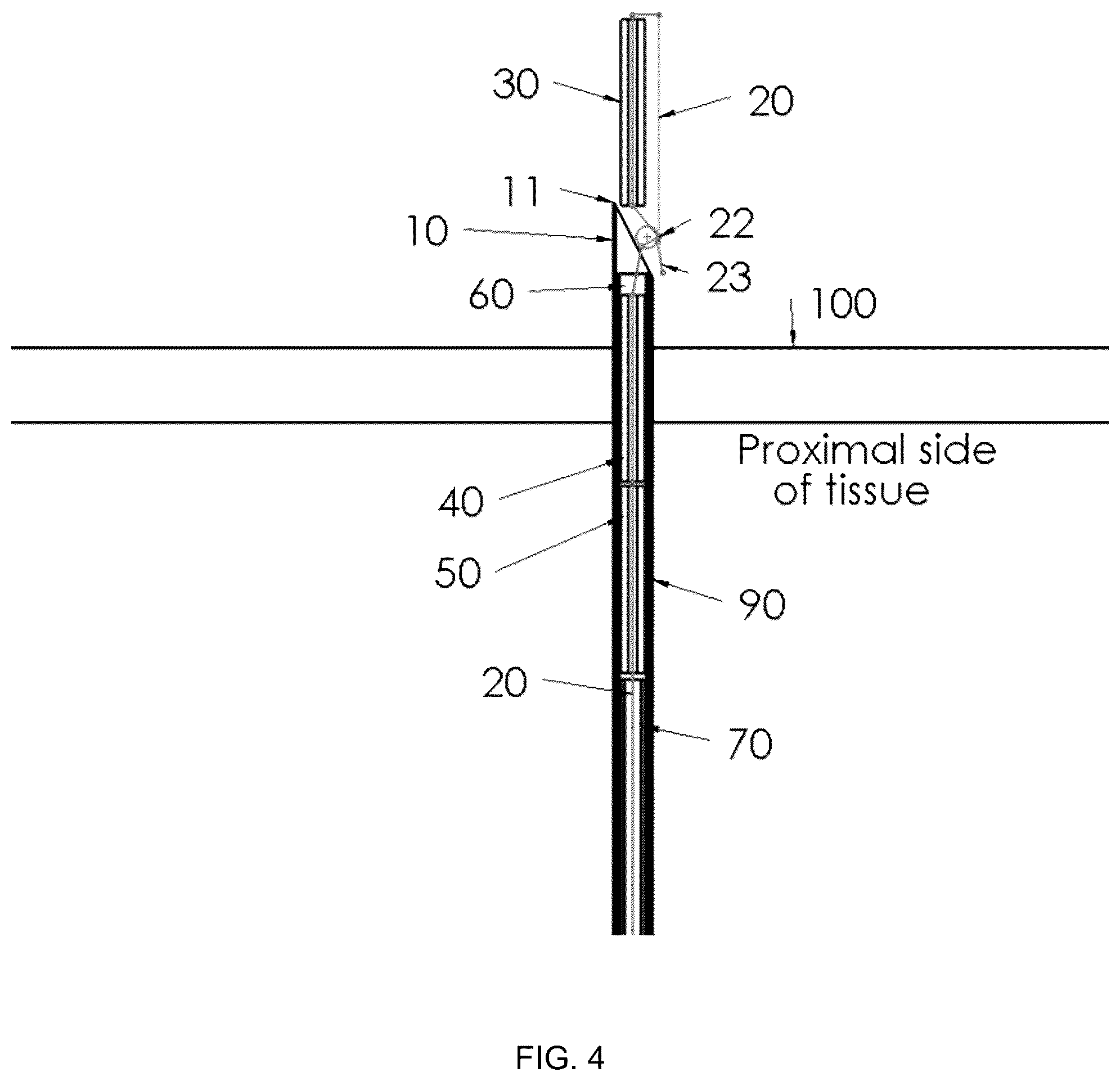 Patent US12396719 Figure 11 – Soft tissue fixation system