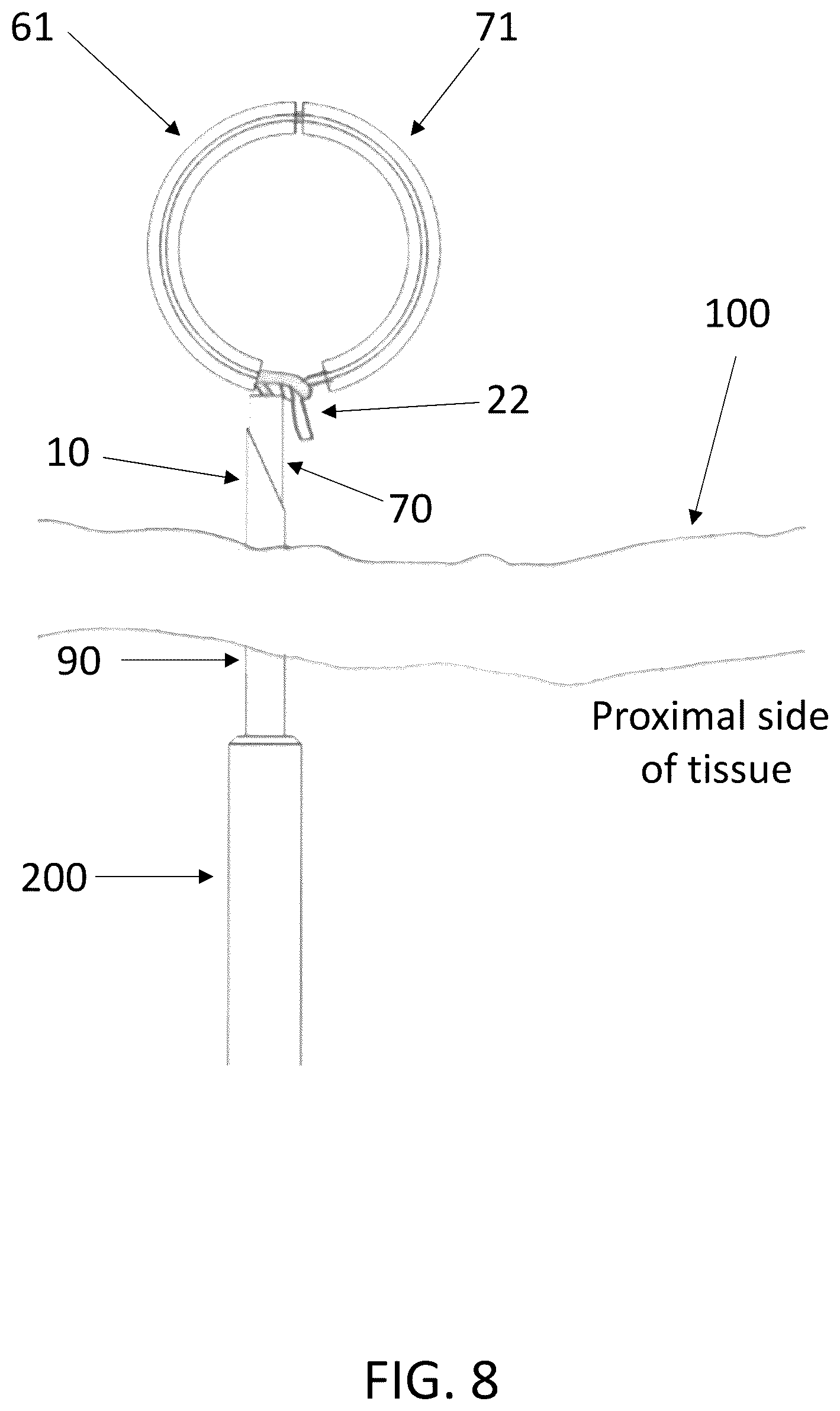 Patent US12396719 Figure 15 – Soft tissue fixation system