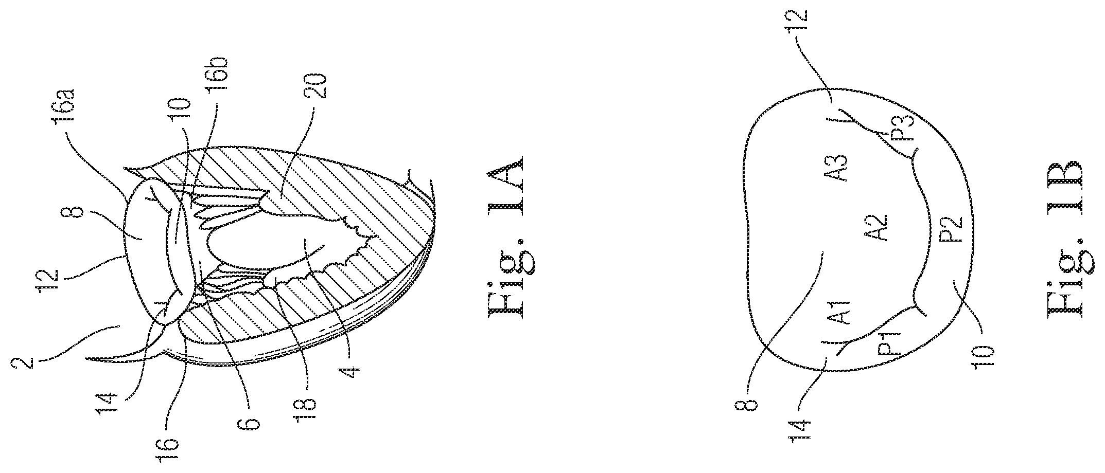 Patent US12396720 Figure 1 – Devices and methods for locating and implanting tissue anchors at mitral valve commissure