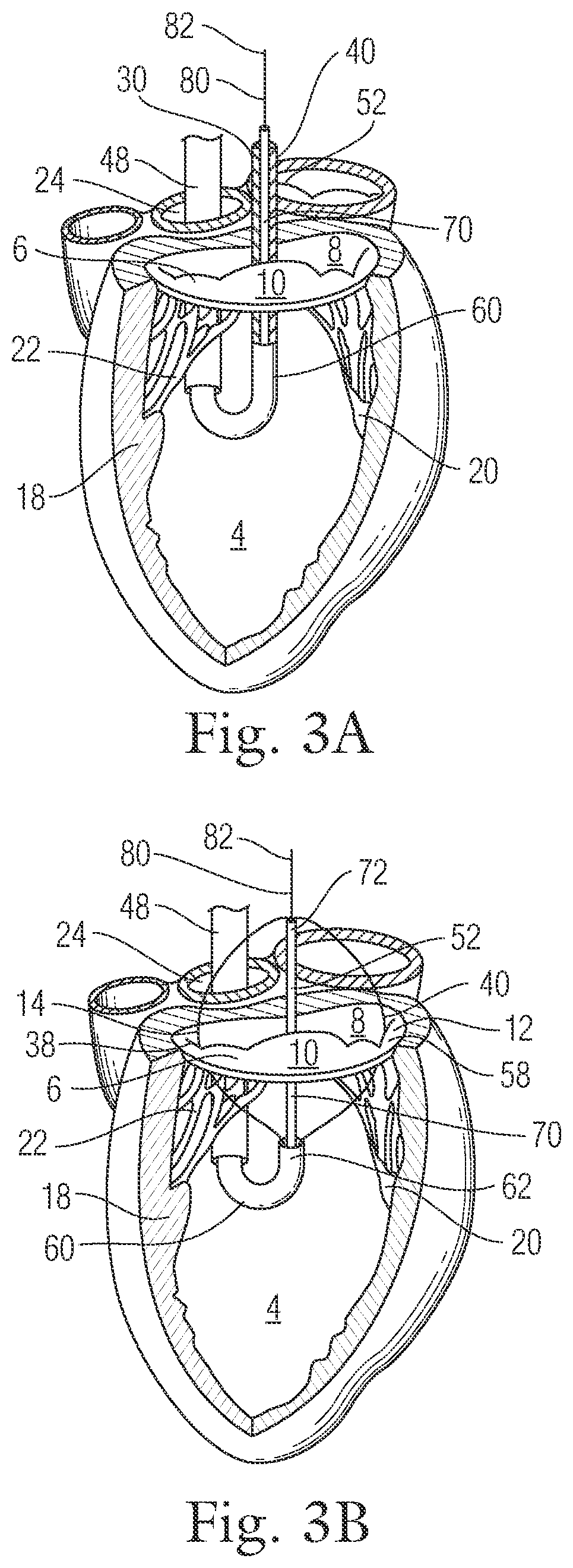 Patent US12396720 Figure 3 – Devices and methods for locating and implanting tissue anchors at mitral valve commissure
