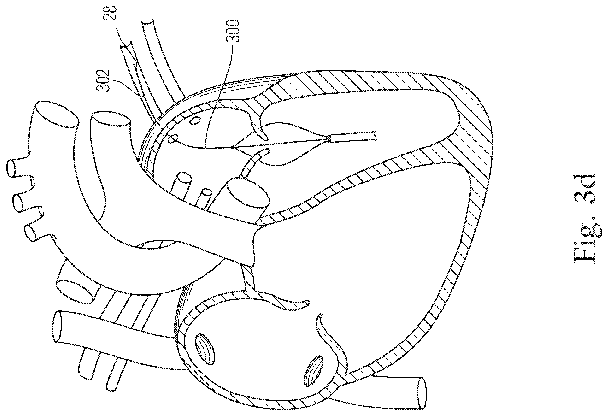 Patent US12396720 Figure 5 – Devices and methods for locating and implanting tissue anchors at mitral valve commissure
