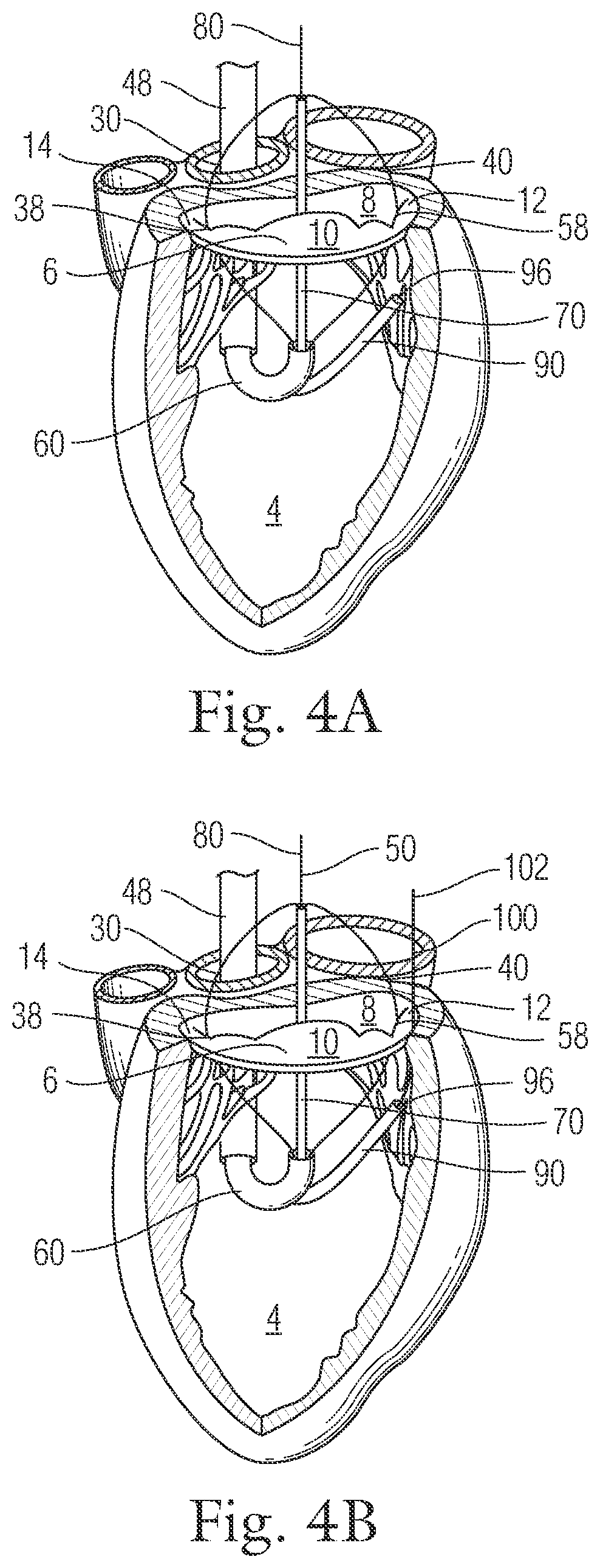 Patent US12396720 Figure 6 – Devices and methods for locating and implanting tissue anchors at mitral valve commissure