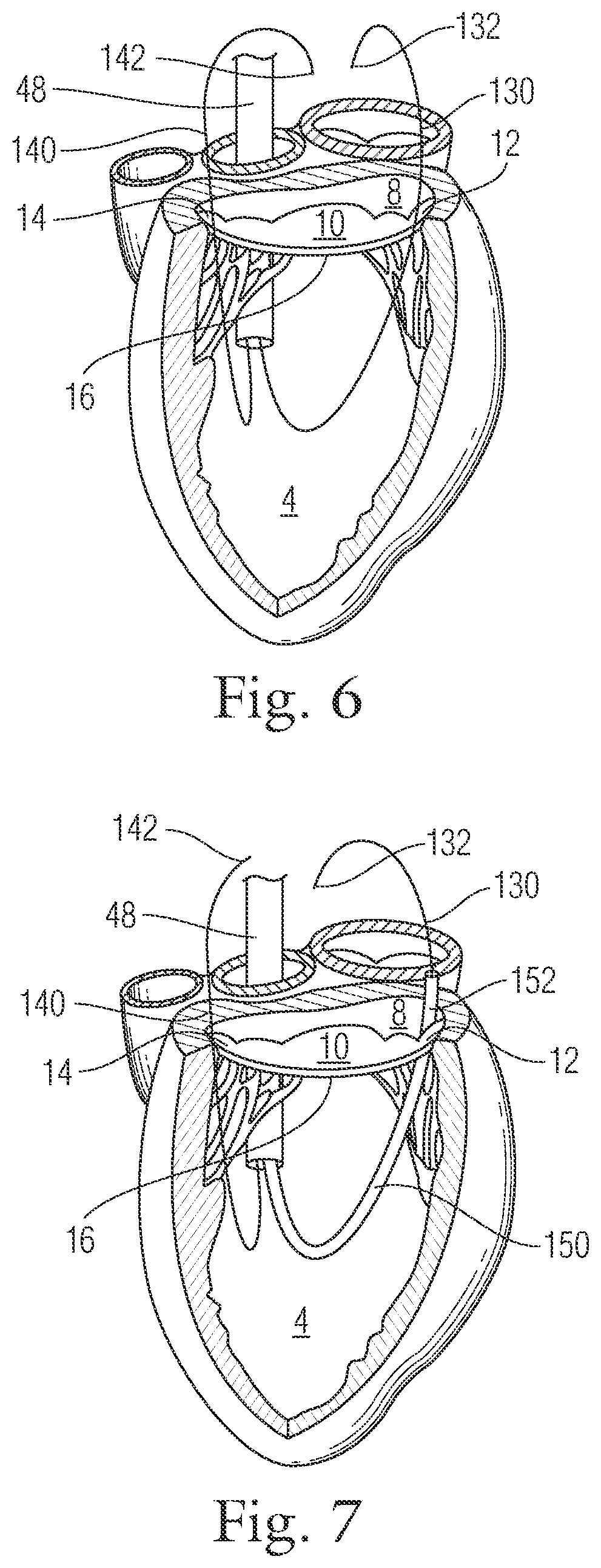 Patent US12396720 Figure 8 – Devices and methods for locating and implanting tissue anchors at mitral valve commissure
