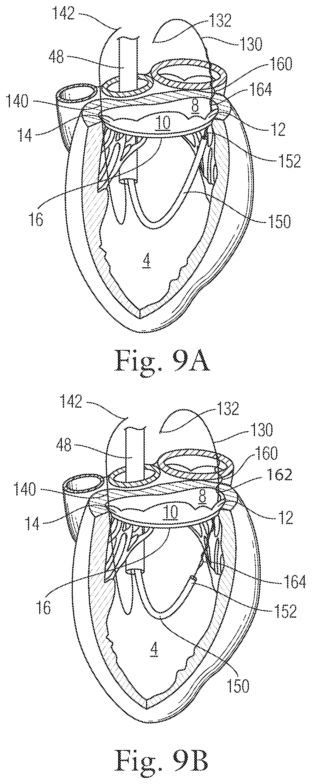 Patent US12396720 Figure 10 – Devices and methods for locating and implanting tissue anchors at mitral valve commissure