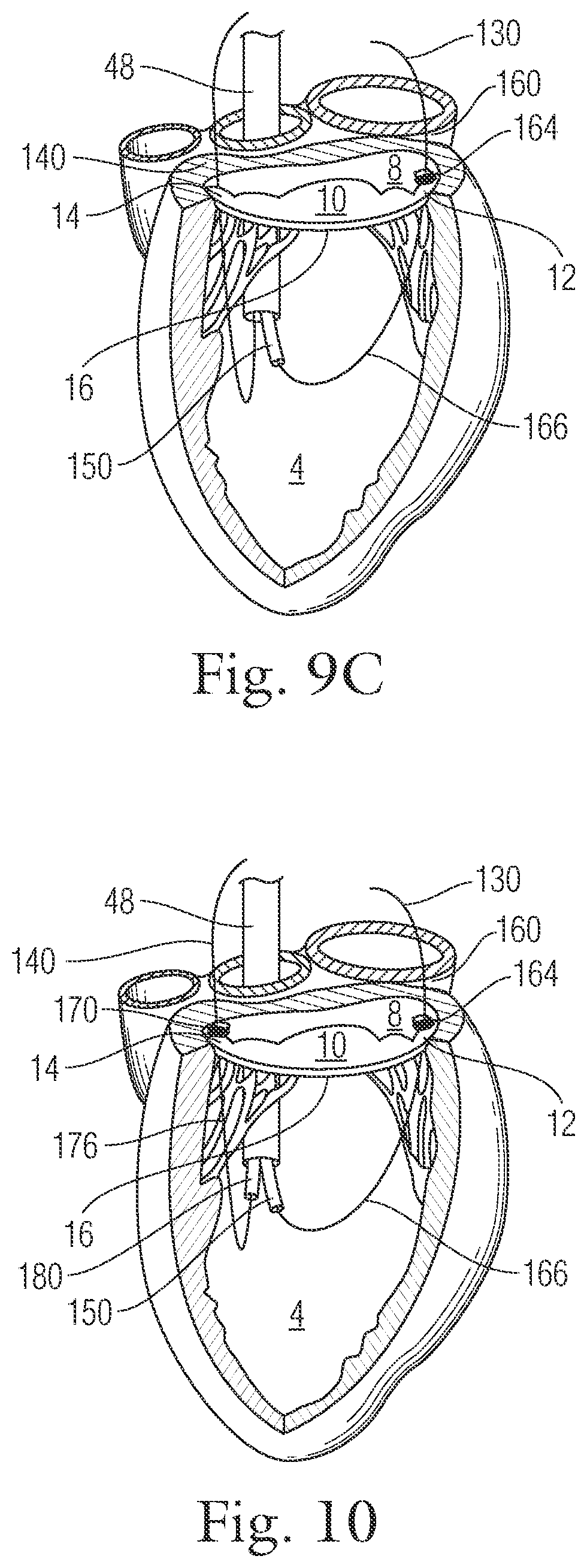 Patent US12396720 Figure 11 – Devices and methods for locating and implanting tissue anchors at mitral valve commissure