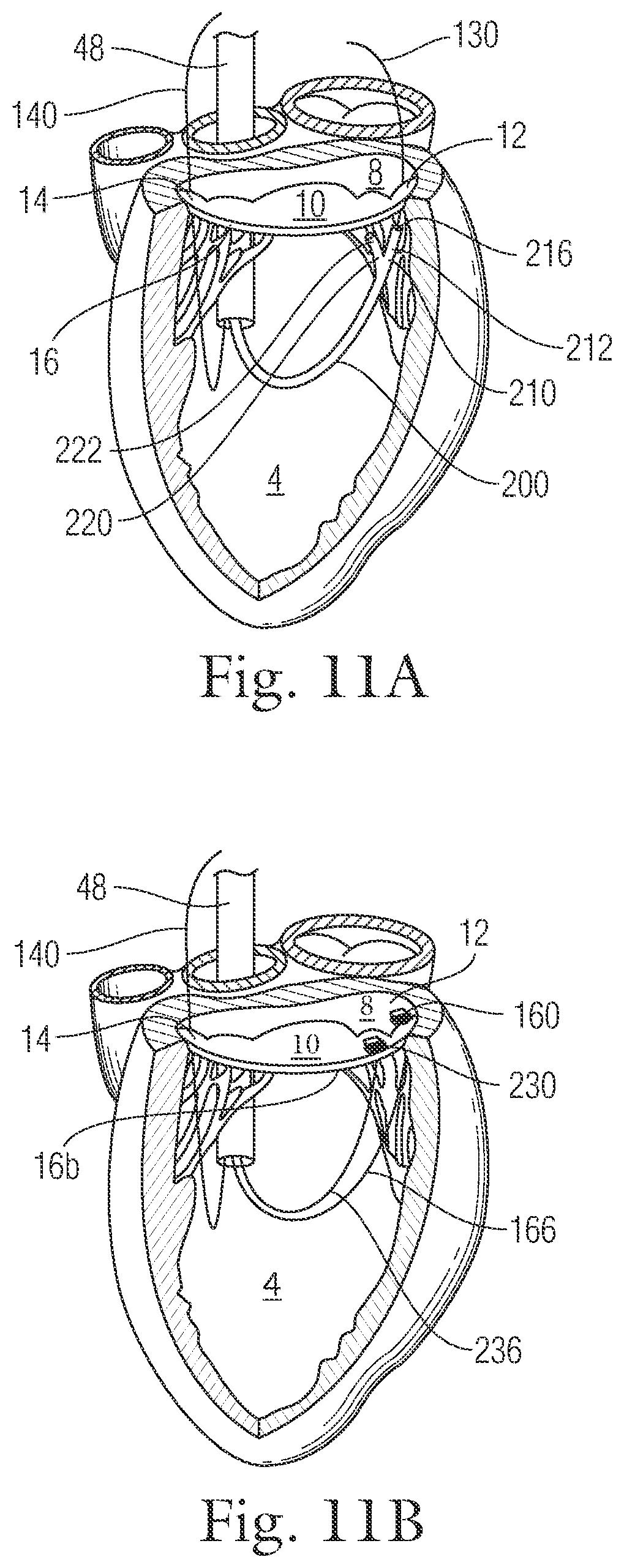 Patent US12396720 Figure 12 – Devices and methods for locating and implanting tissue anchors at mitral valve commissure