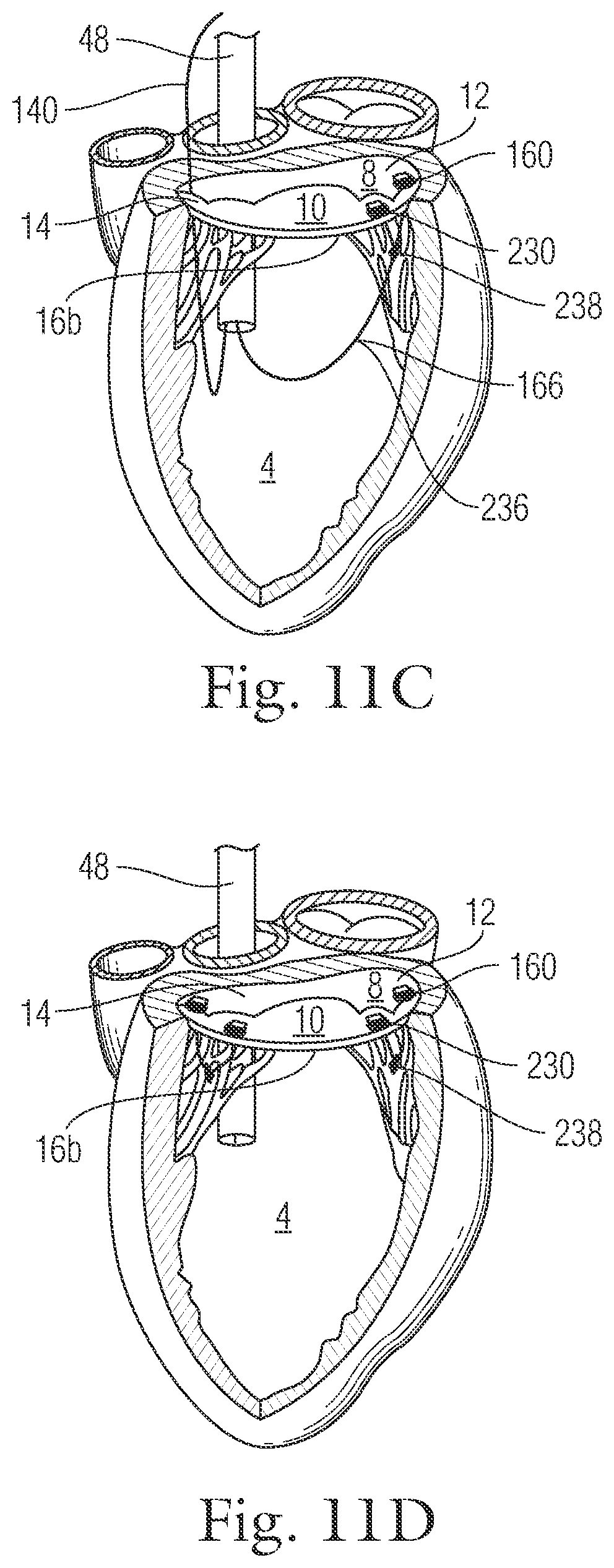 Patent US12396720 Figure 13 – Devices and methods for locating and implanting tissue anchors at mitral valve commissure