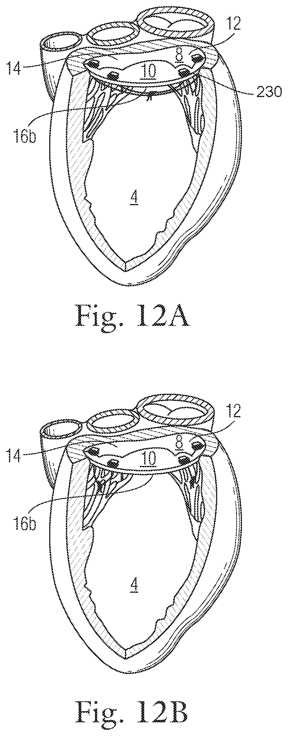 Patent US12396720 Figure 14 – Devices and methods for locating and implanting tissue anchors at mitral valve commissure