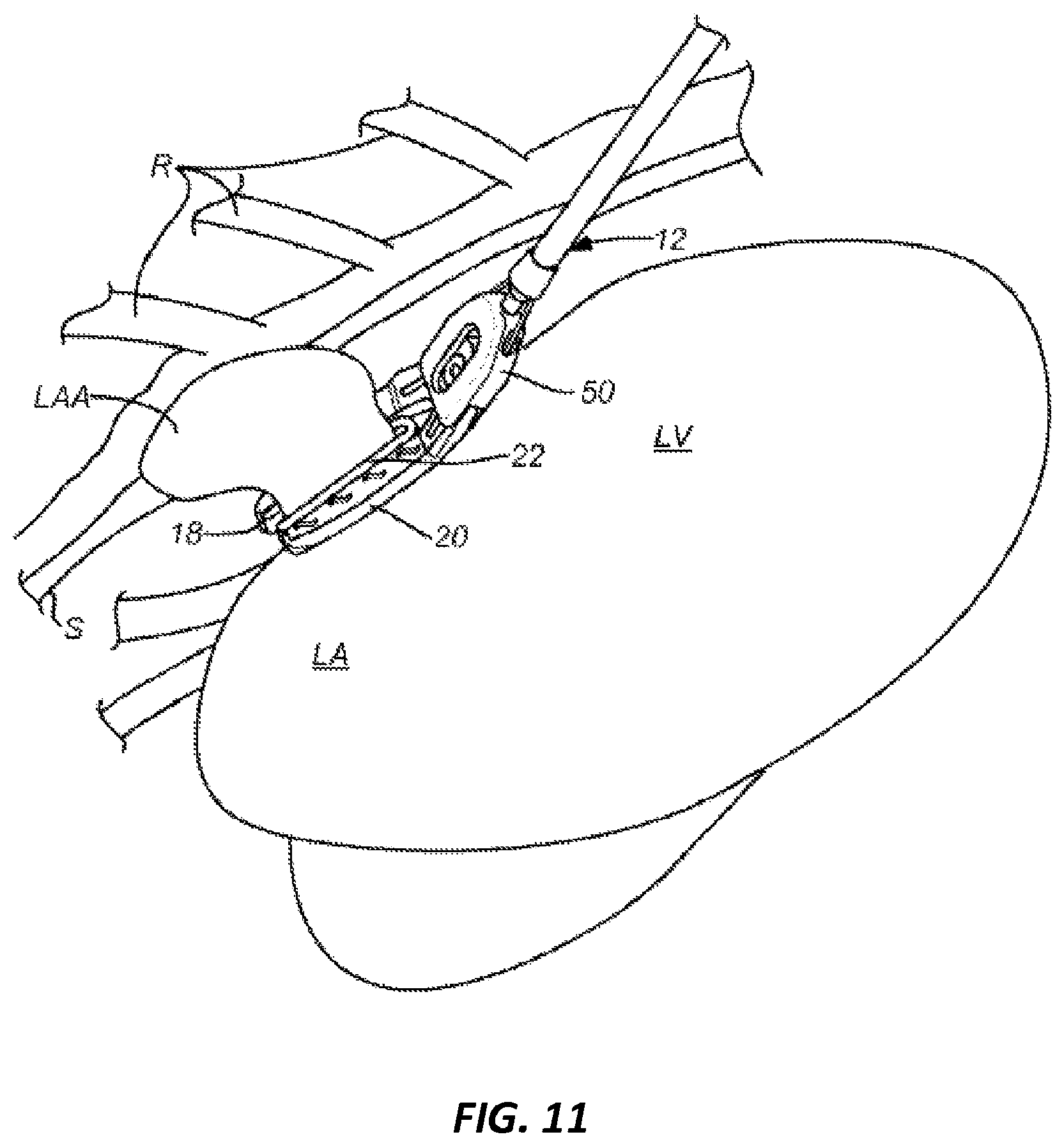 Patent US12396729 Figure 14 – Fastener applicator with interlock
