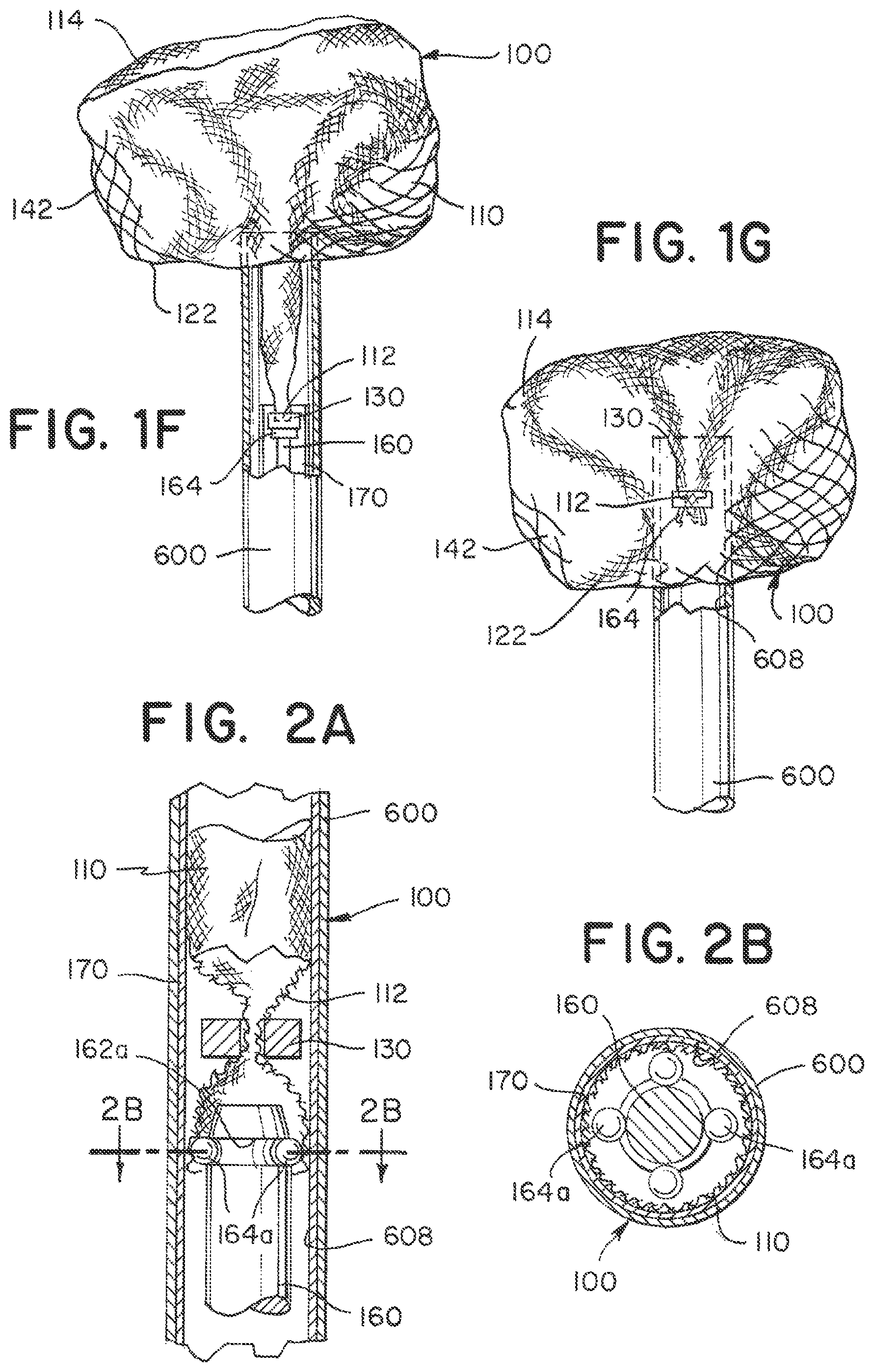 Patent US12396730 Figure 3 – Braided implant with detachment mechanism