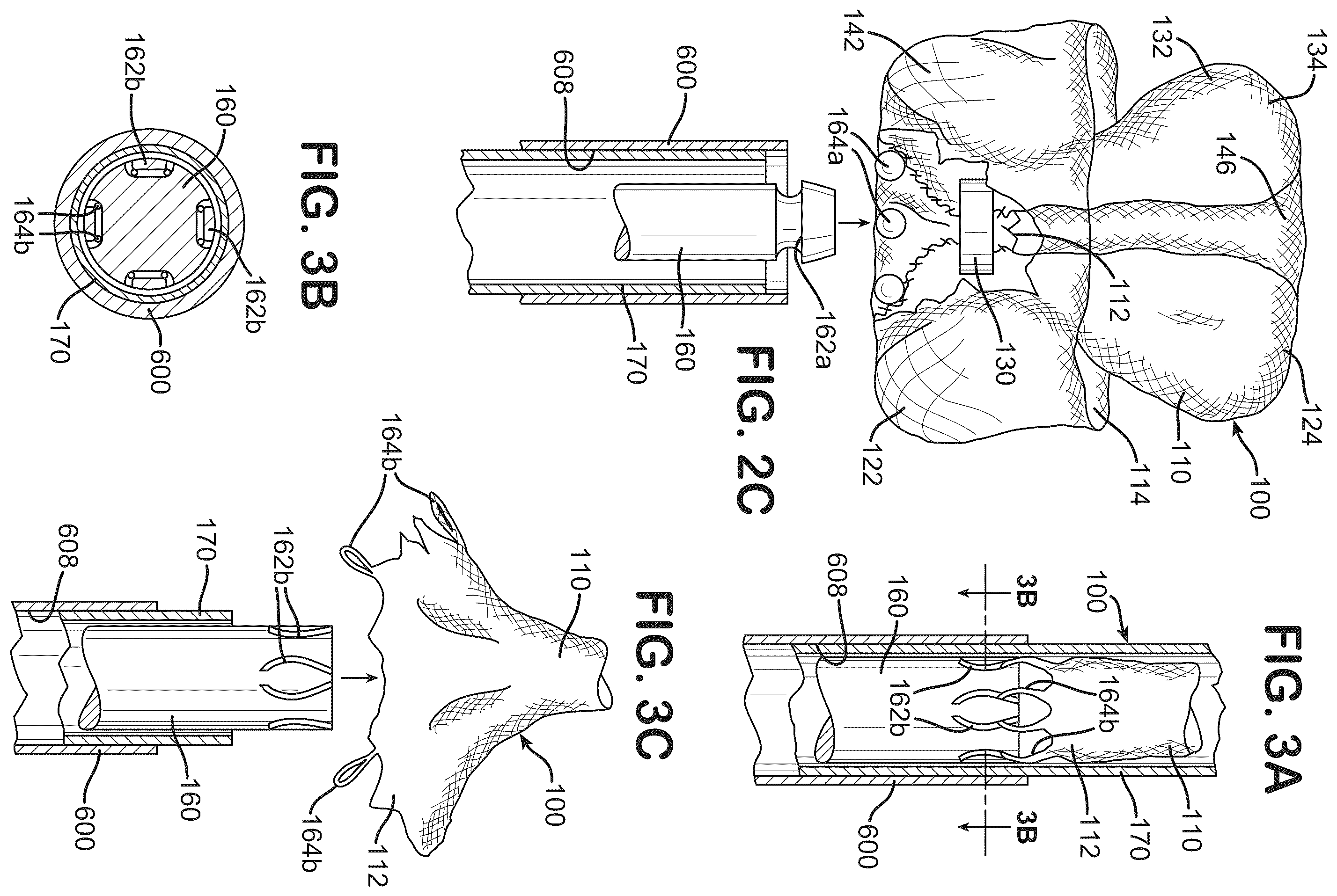 Patent US12396730 Figure 4 – Braided implant with detachment mechanism