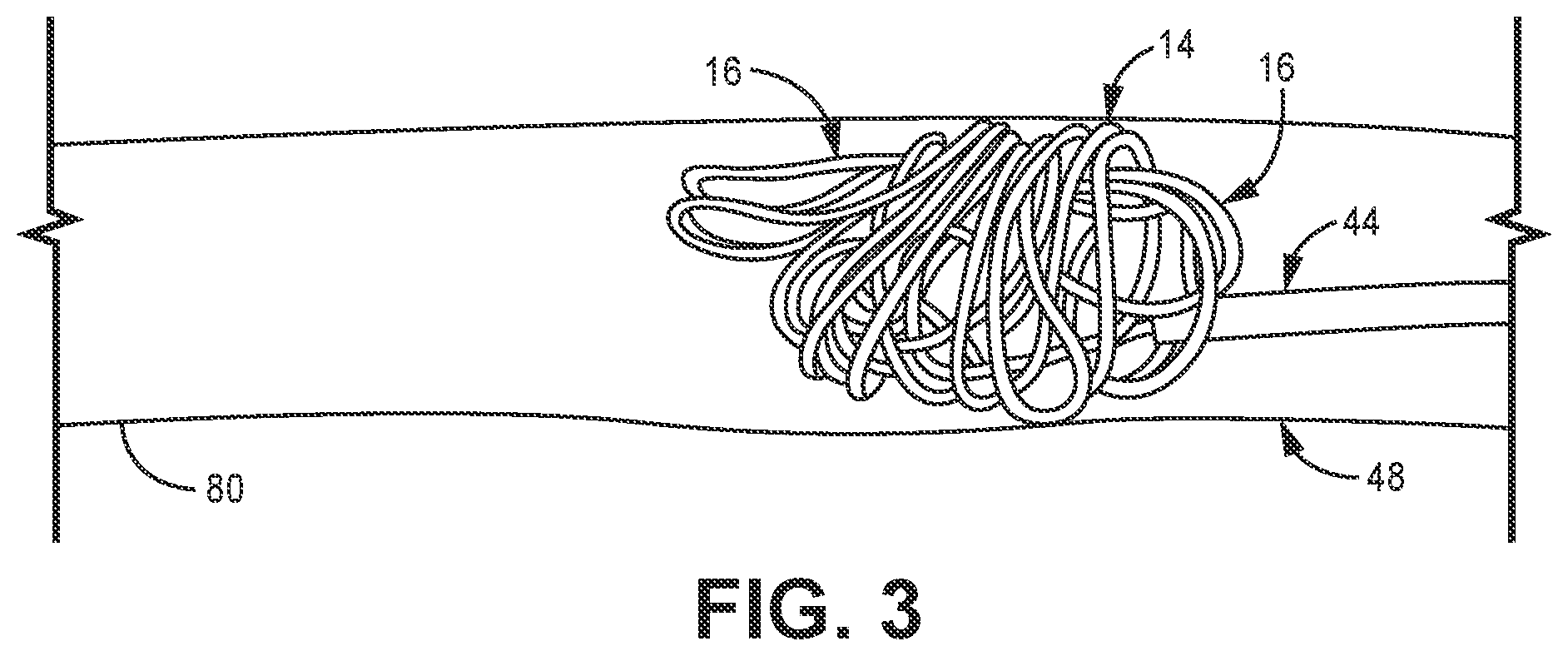 Patent US12396731 Figure 3 – Implantable embolization device