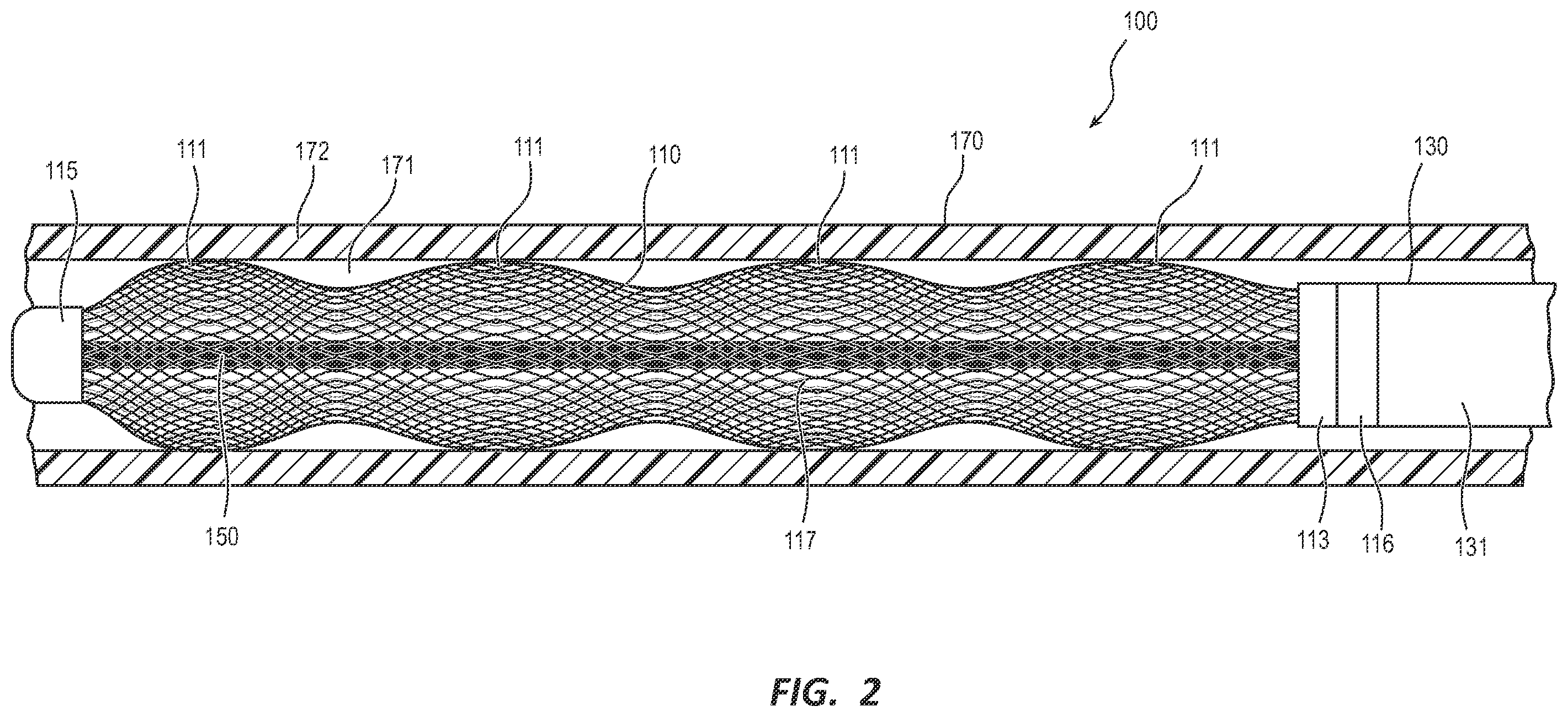 Patent US12396732 Figure 2 – Expanding medical device with support