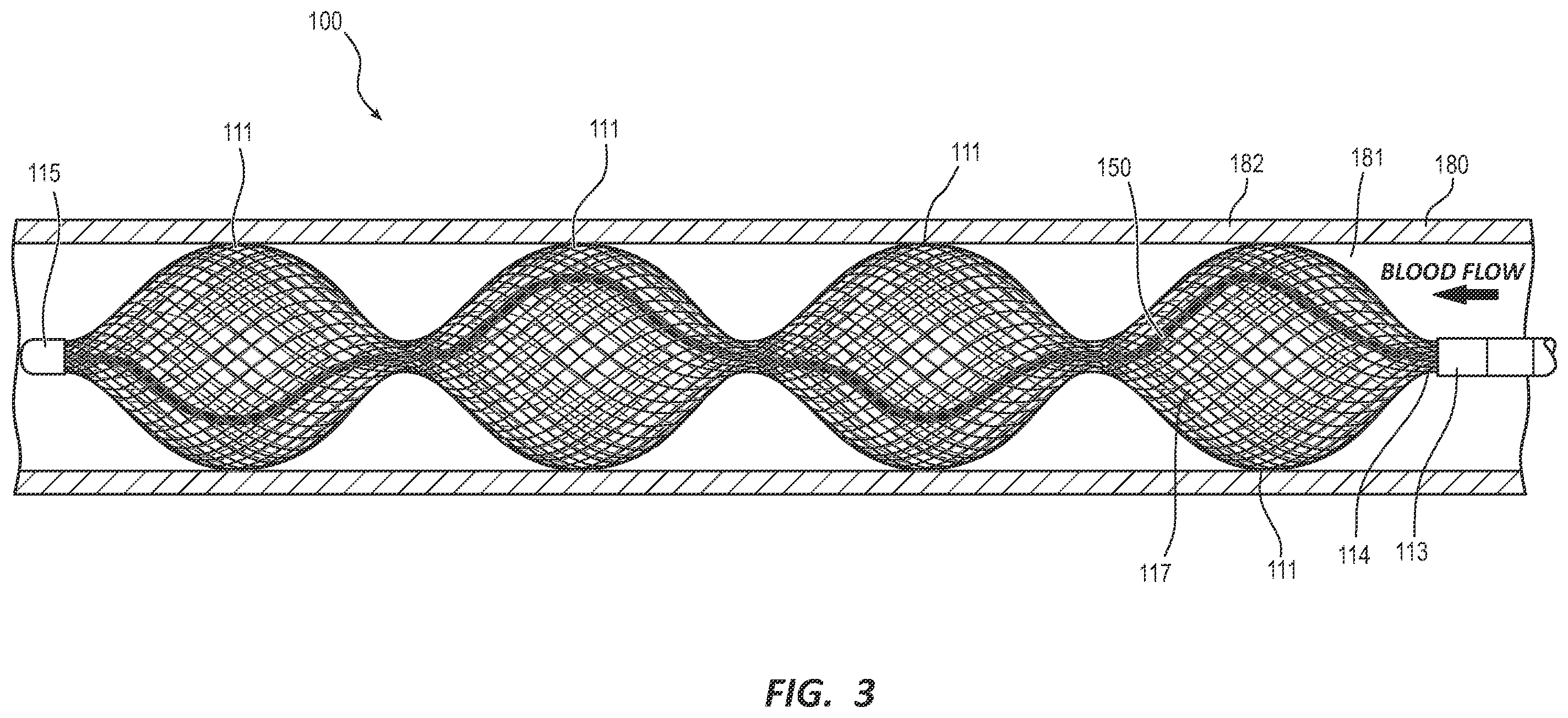 Patent US12396732 Figure 3 – Expanding medical device with support