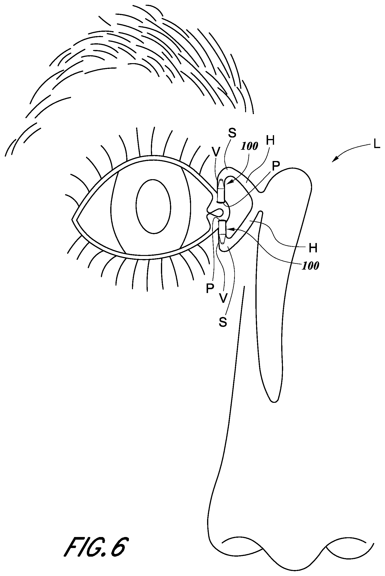 Patent US12396734 Figure 5 – Devices and methods for occluding the punctal opening