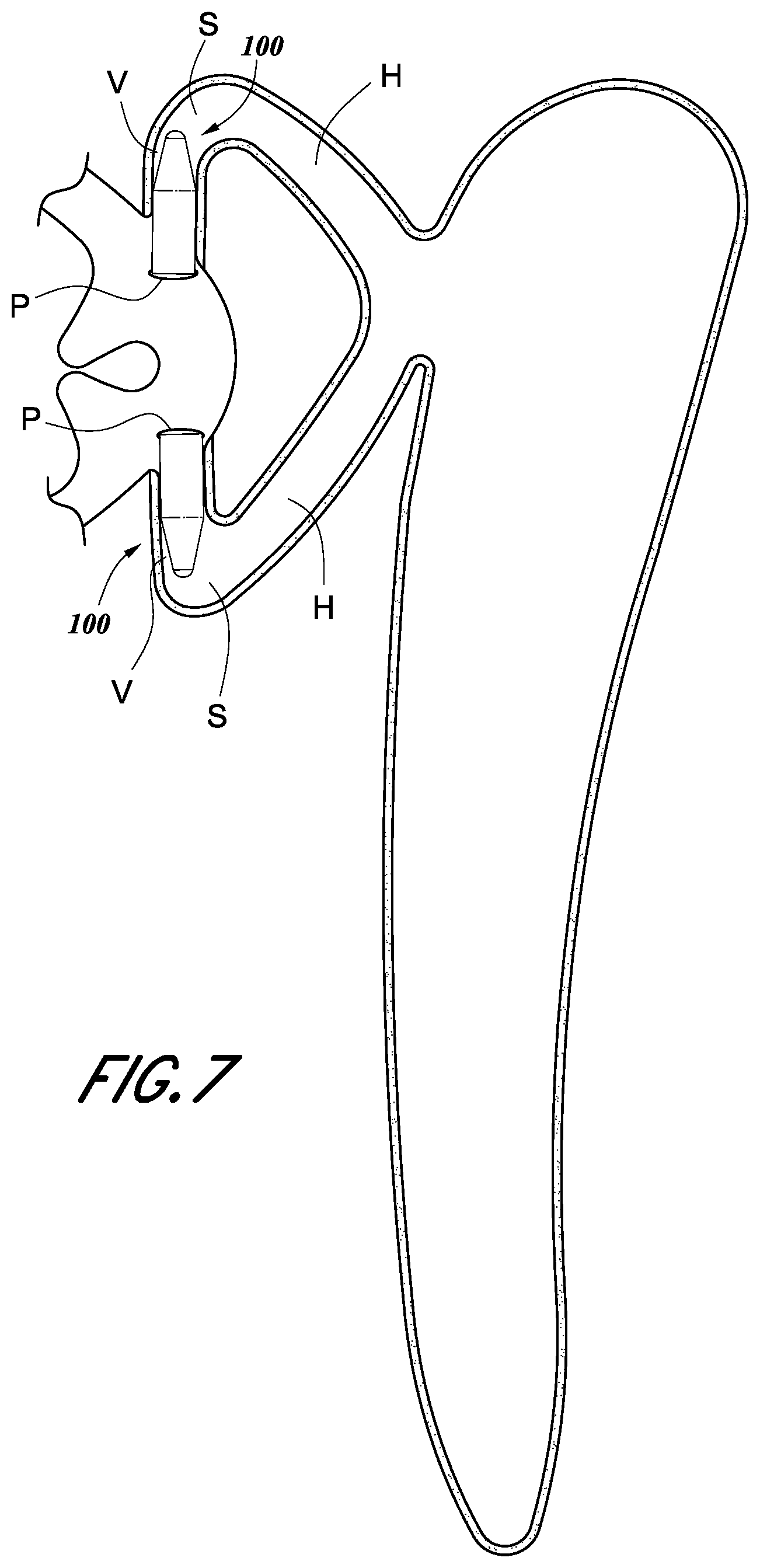 Patent US12396734 Figure 6 – Devices and methods for occluding the punctal opening