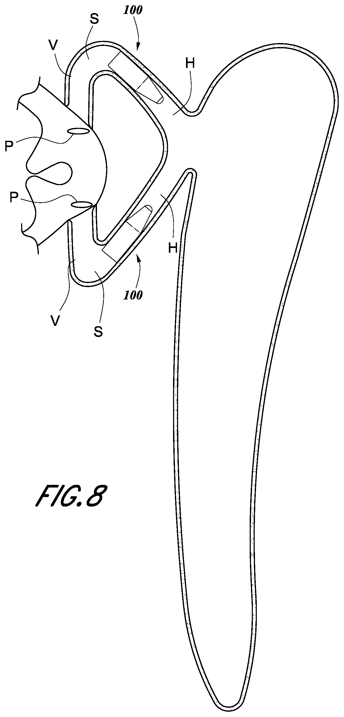 Patent US12396734 Figure 7 – Devices and methods for occluding the punctal opening