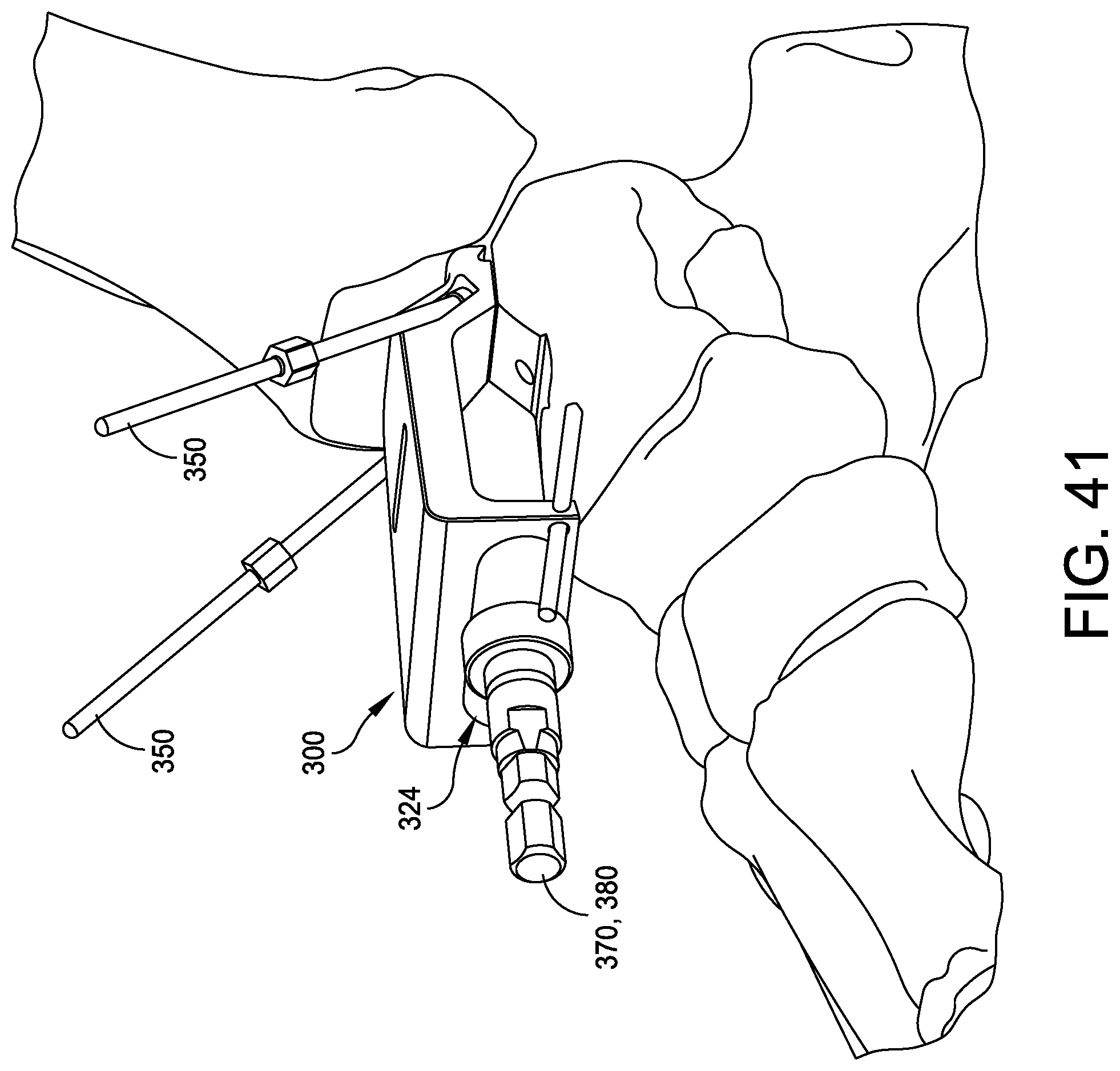 Patent US12396737 Figure 17 – Chamfer guidance systems and methods