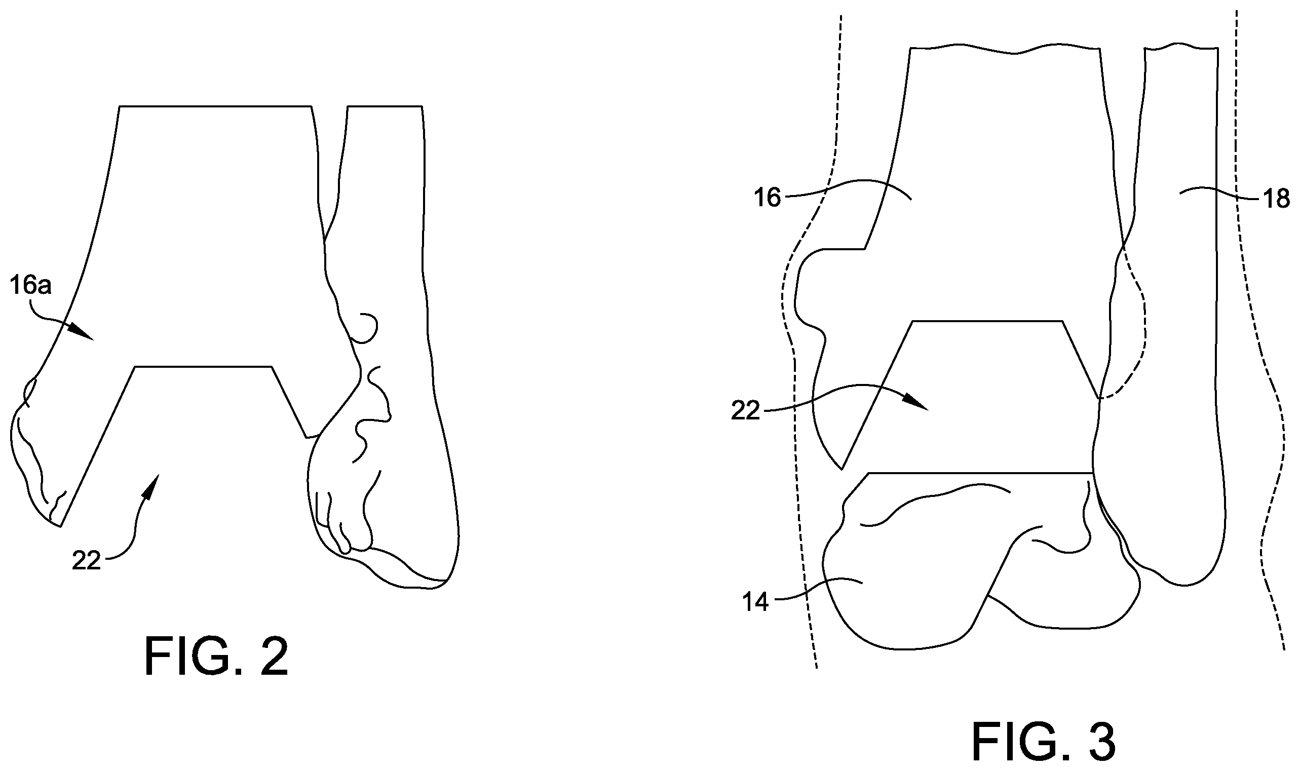 Patent US12396739 Figure 2 – Guidance tools, systems, and methods