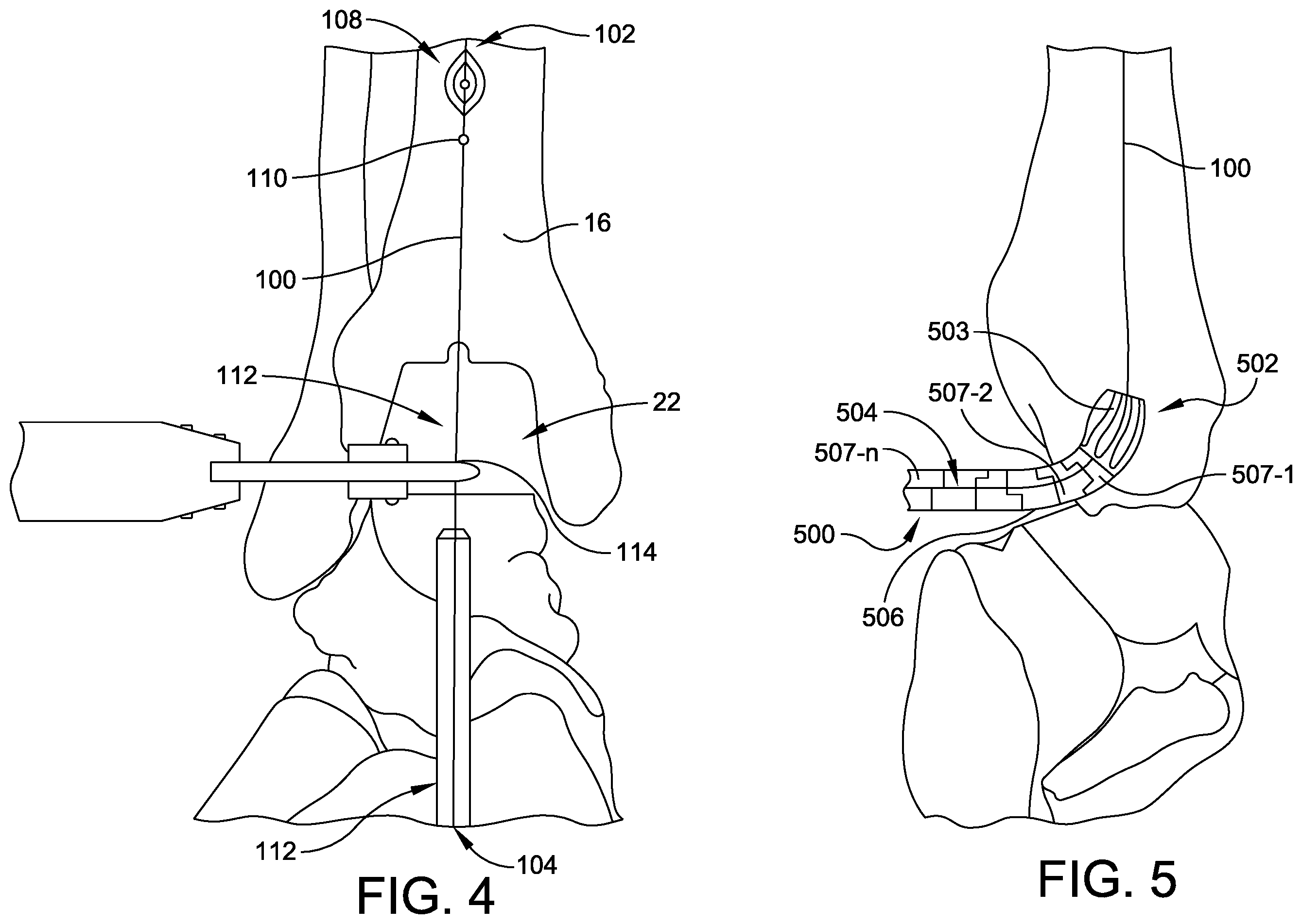 Patent US12396739 Figure 3 – Guidance tools, systems, and methods