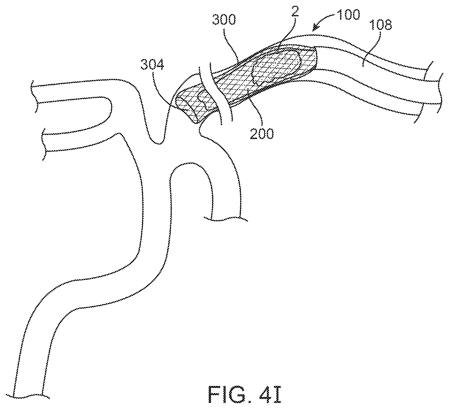 Patent US12396743 Figure 10 – Retrieval systems and methods for use thereof
