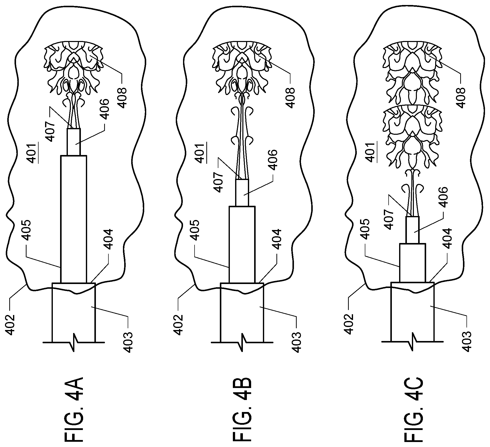 Patent US12396750 Figure 4 – Adjustable stepped cannula