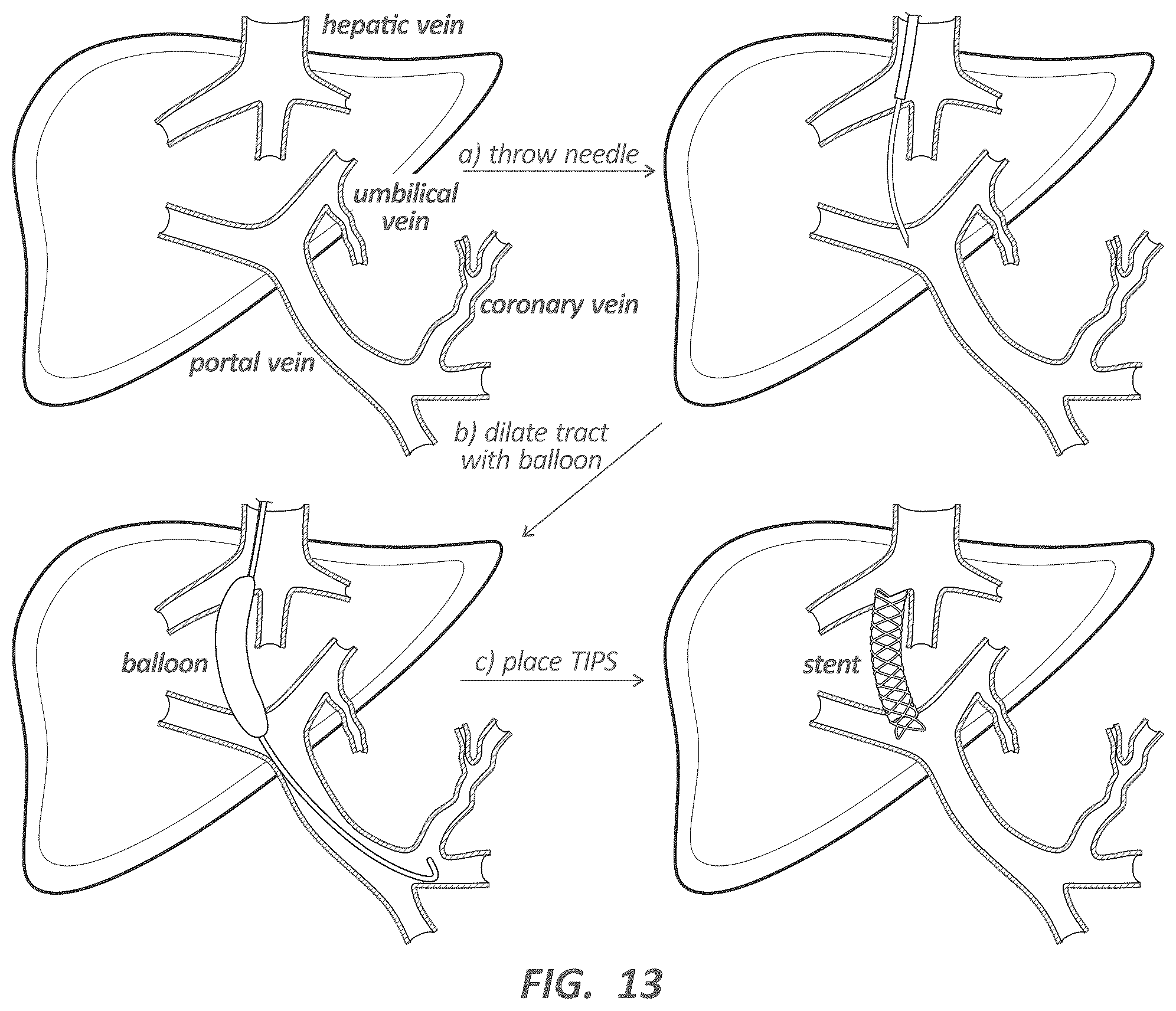 Patent US12396753 Figure 13 – Needle-tract assistant including components and methods thereof