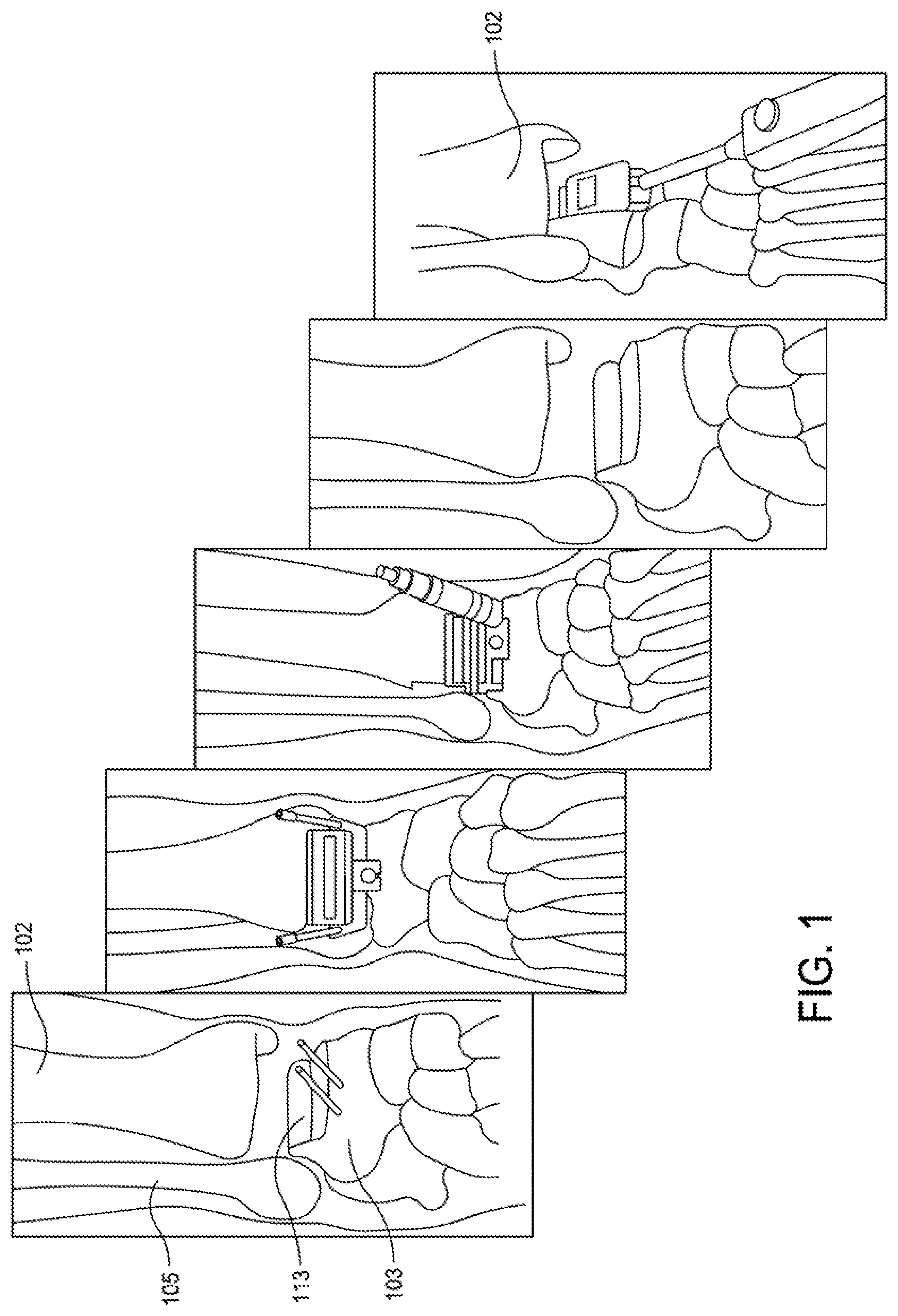 Patent US12396755 Figure 1 – Methods and apparatus for joint repair