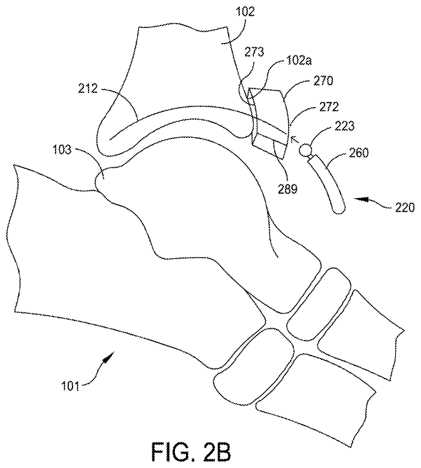 Patent US12396755 Figure 3 – Methods and apparatus for joint repair