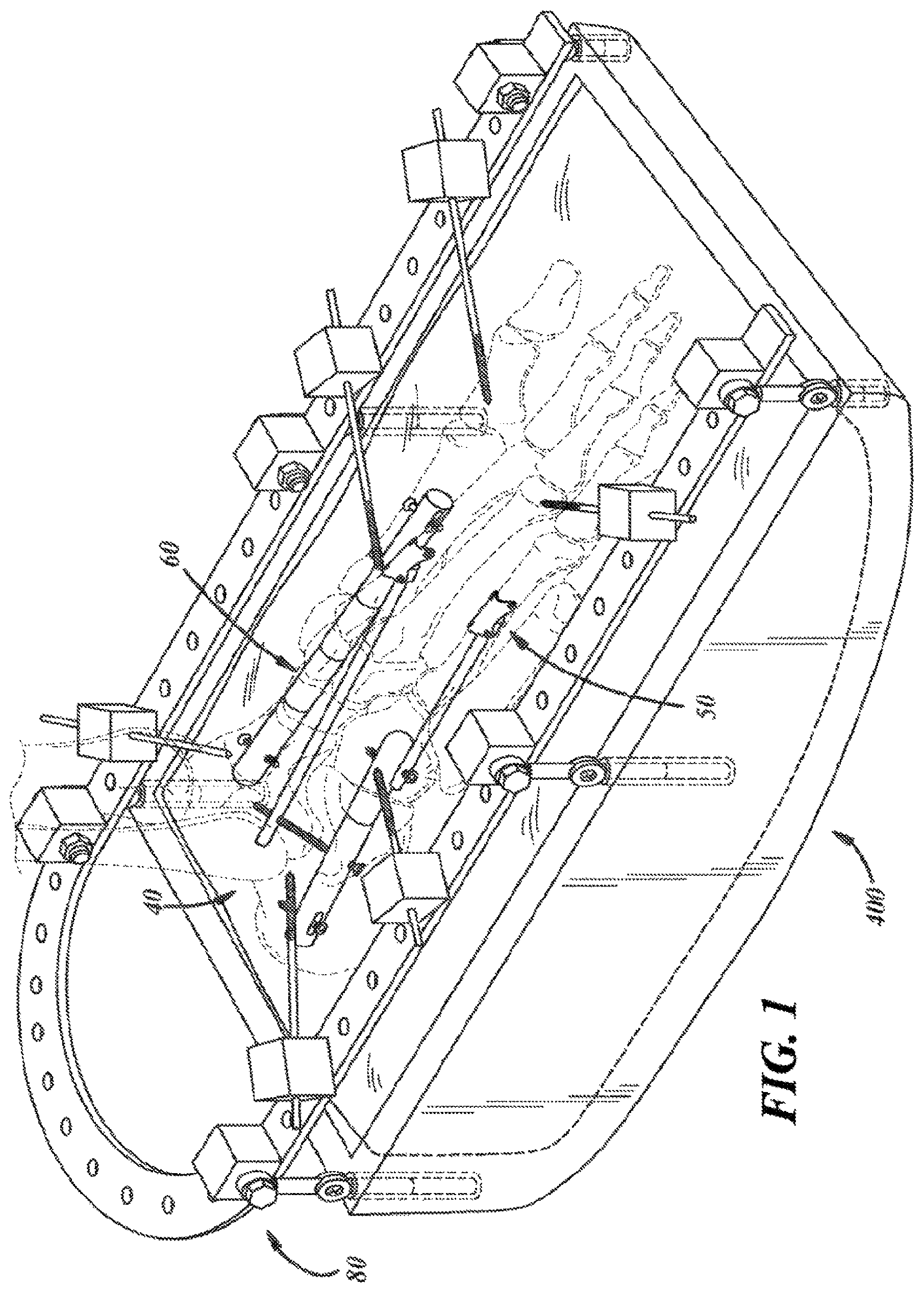 Patent US12396757 — Implants and methods for treating Charcot foot and other conditions — Figure 1