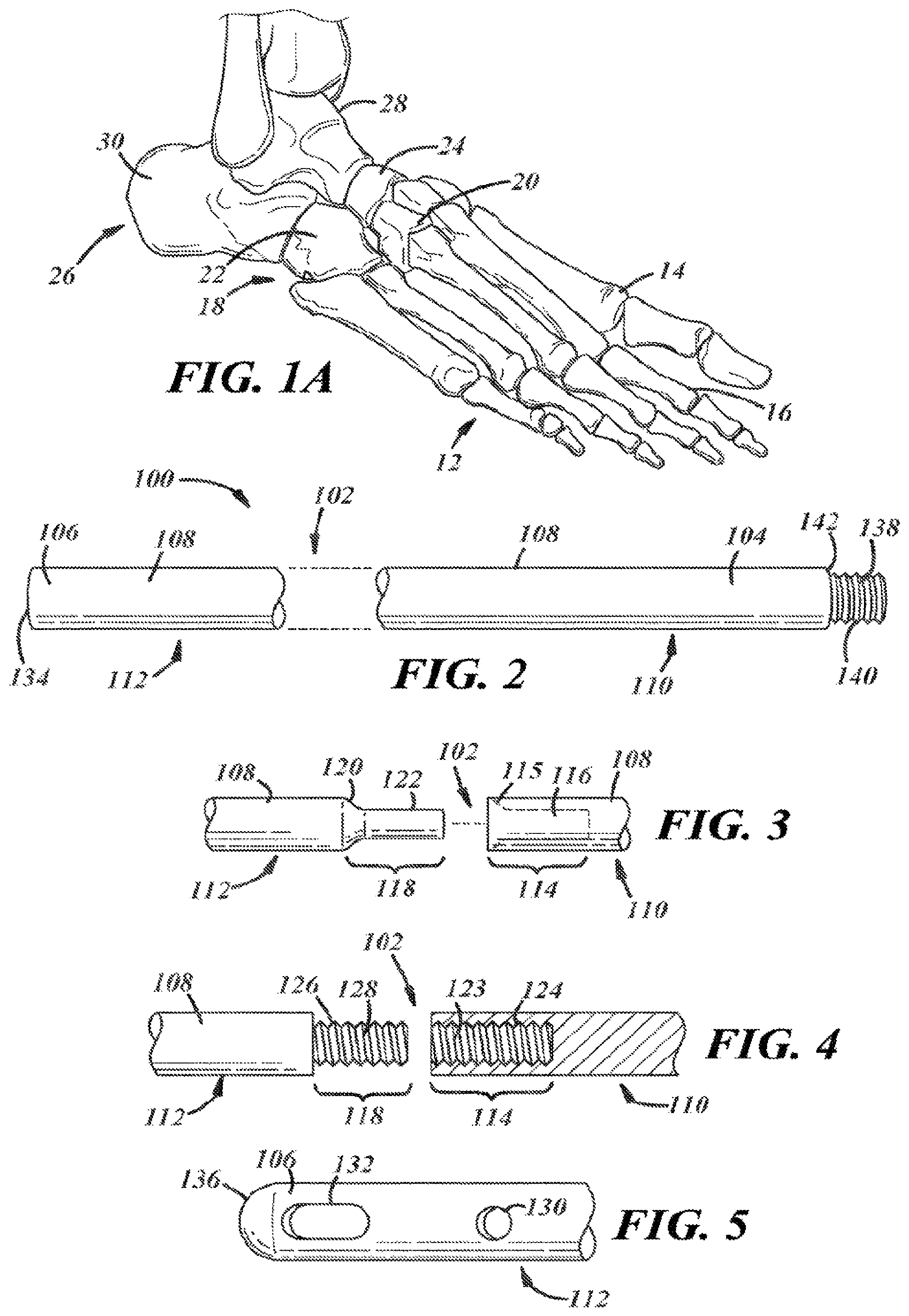 Patent US12396757 Figure 2 – Implants and methods for treating Charcot foot and other conditions