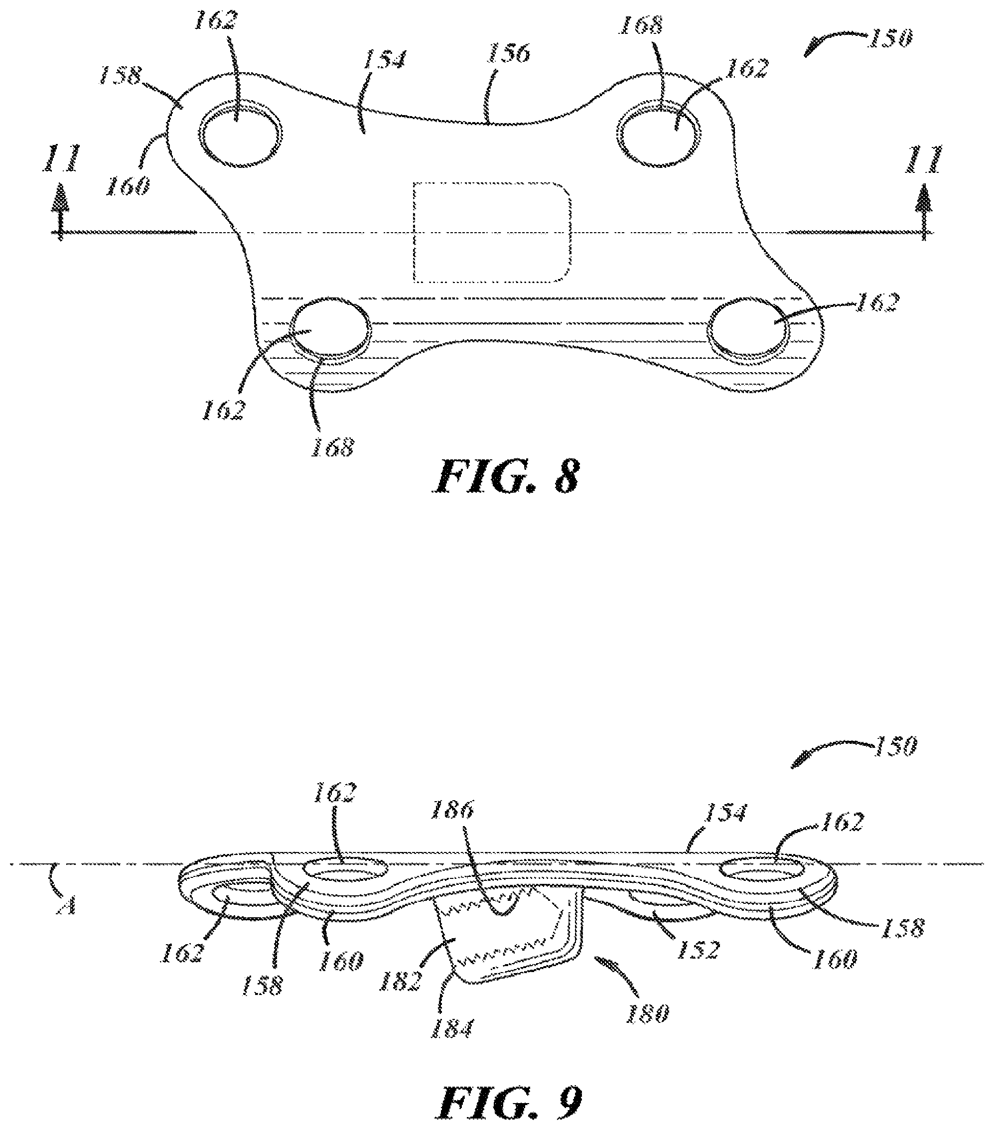 Patent US12396757 Figure 4 – Implants and methods for treating Charcot foot and other conditions