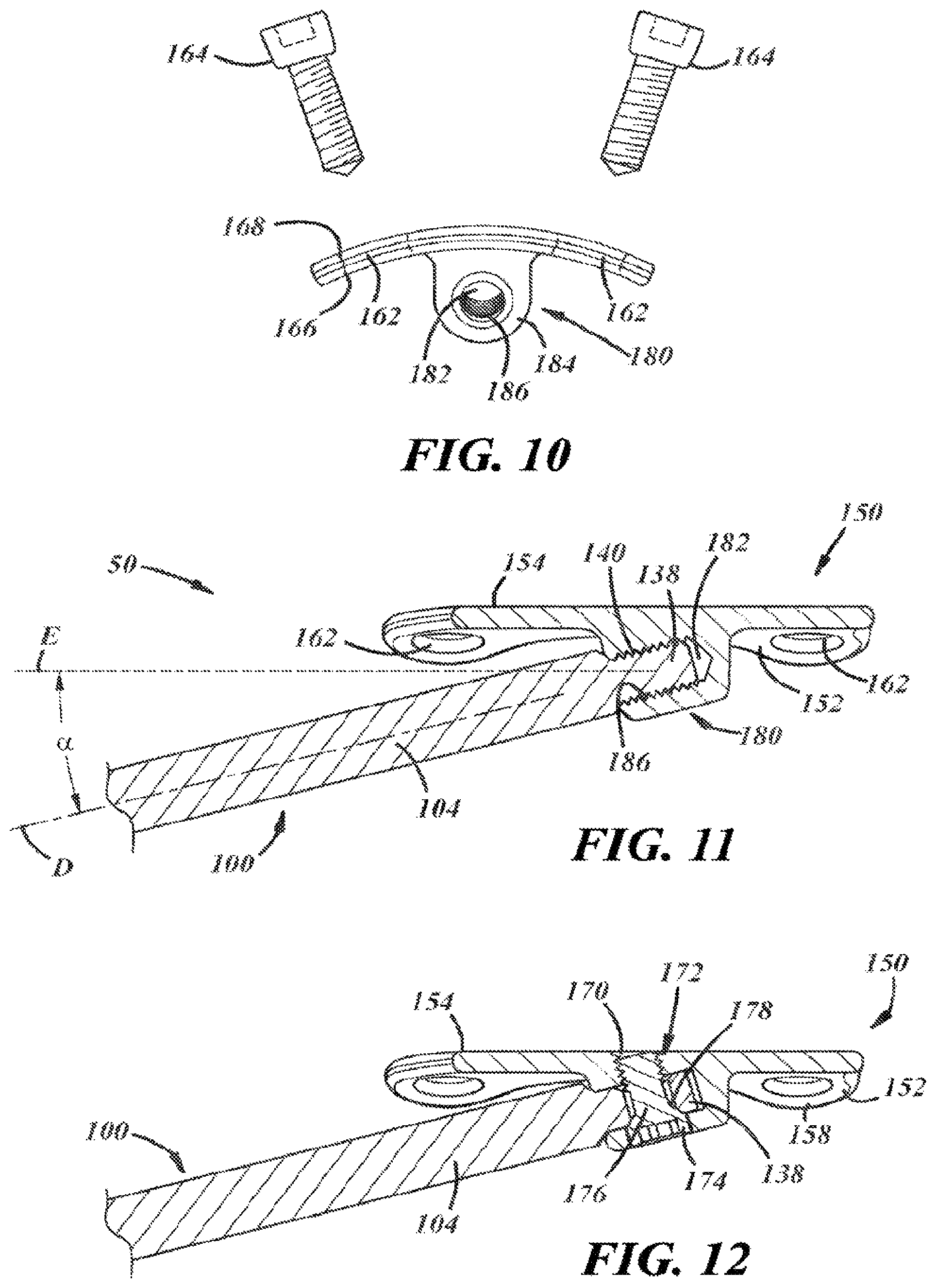 Patent US12396757 Figure 5 – Implants and methods for treating Charcot foot and other conditions