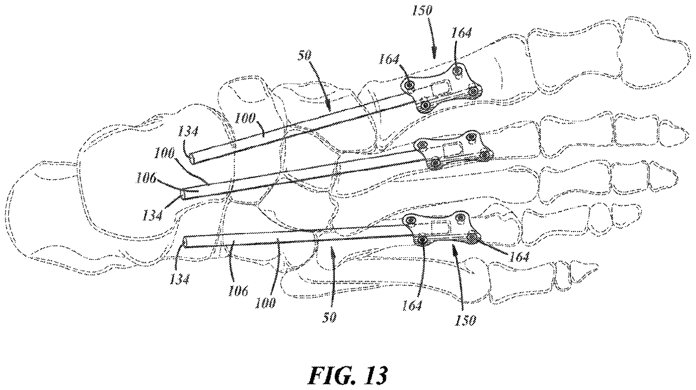 Patent US12396757 Figure 6 – Implants and methods for treating Charcot foot and other conditions