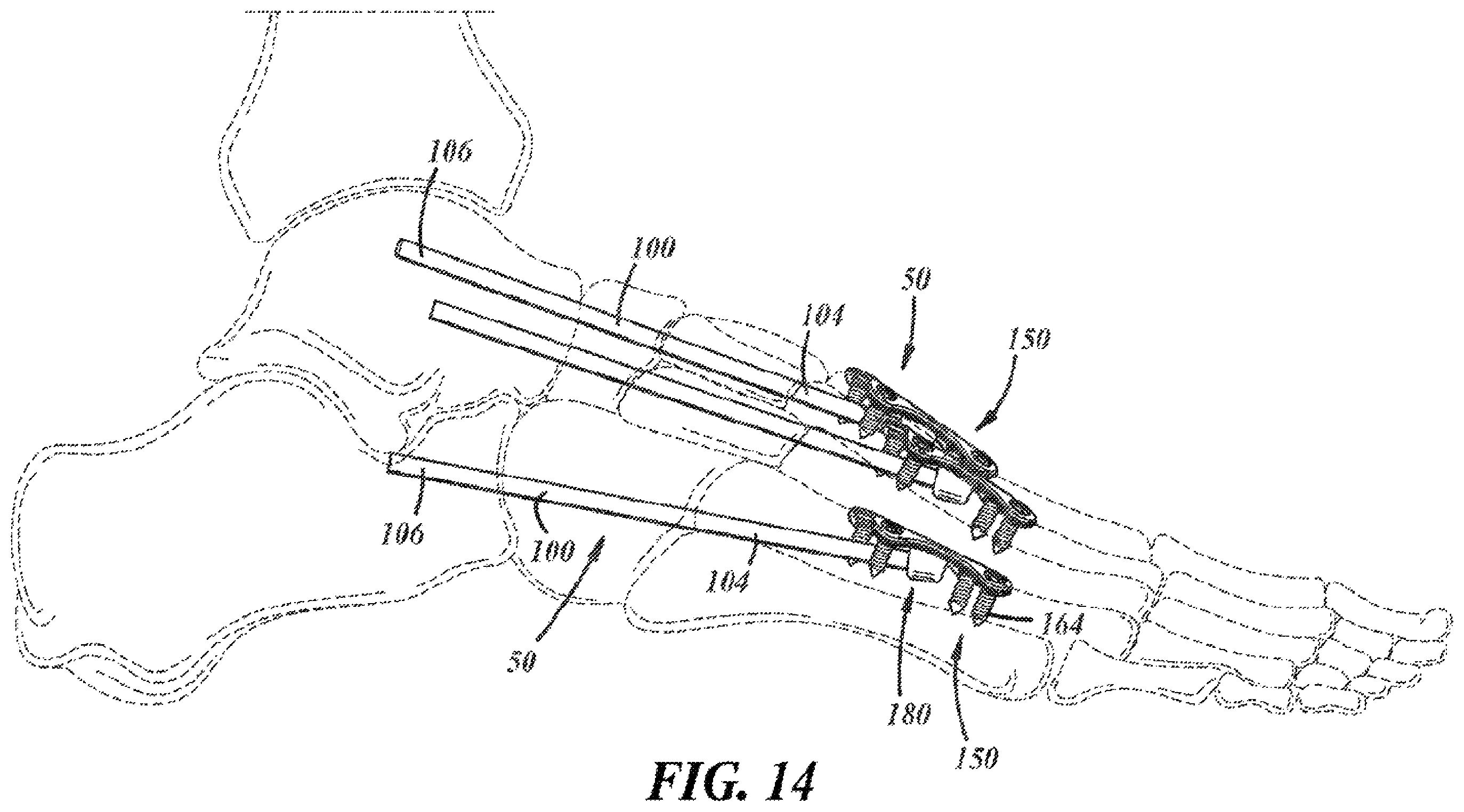 Patent US12396757 Figure 7 – Implants and methods for treating Charcot foot and other conditions