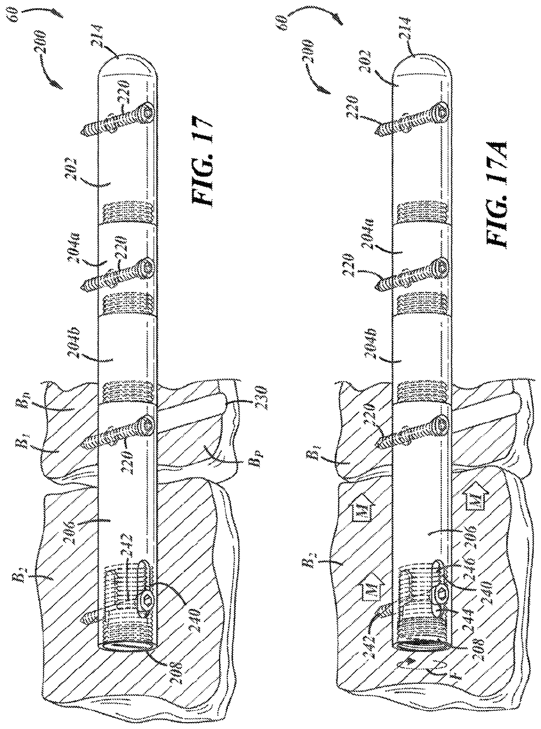 Patent US12396757 Figure 9 – Implants and methods for treating Charcot foot and other conditions