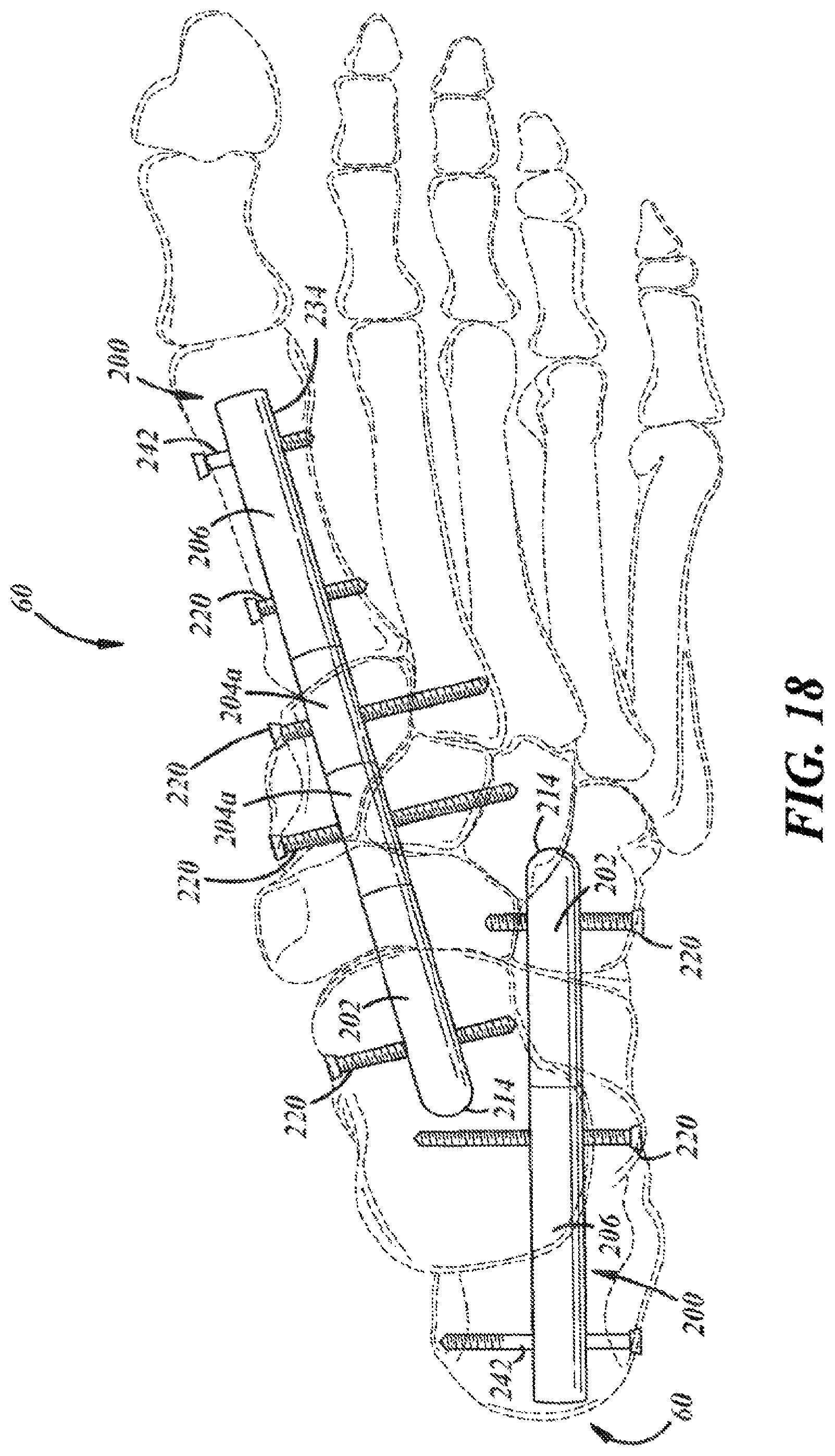 Patent US12396757 Figure 10 – Implants and methods for treating Charcot foot and other conditions