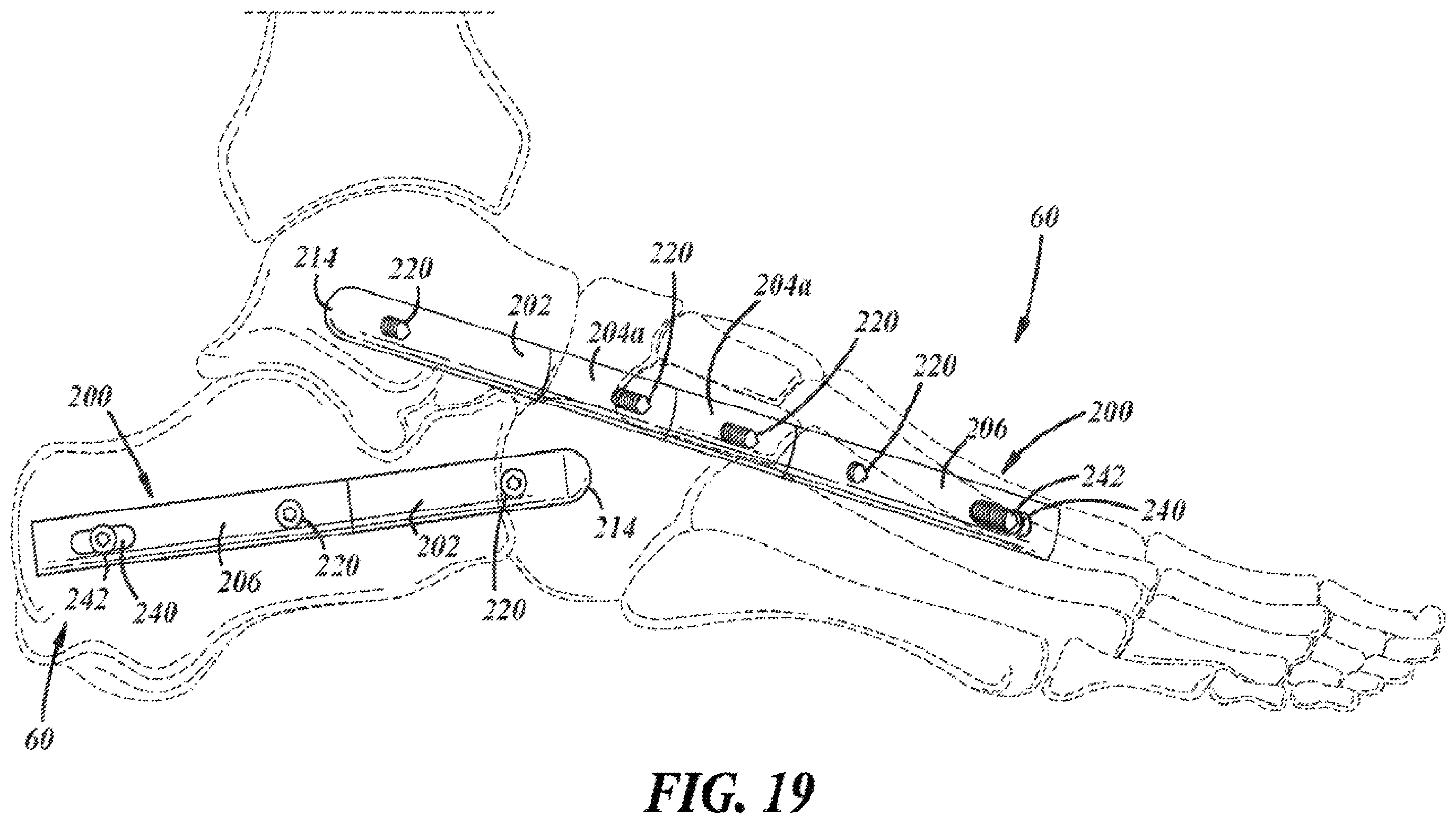 Patent US12396757 Figure 11 – Implants and methods for treating Charcot foot and other conditions