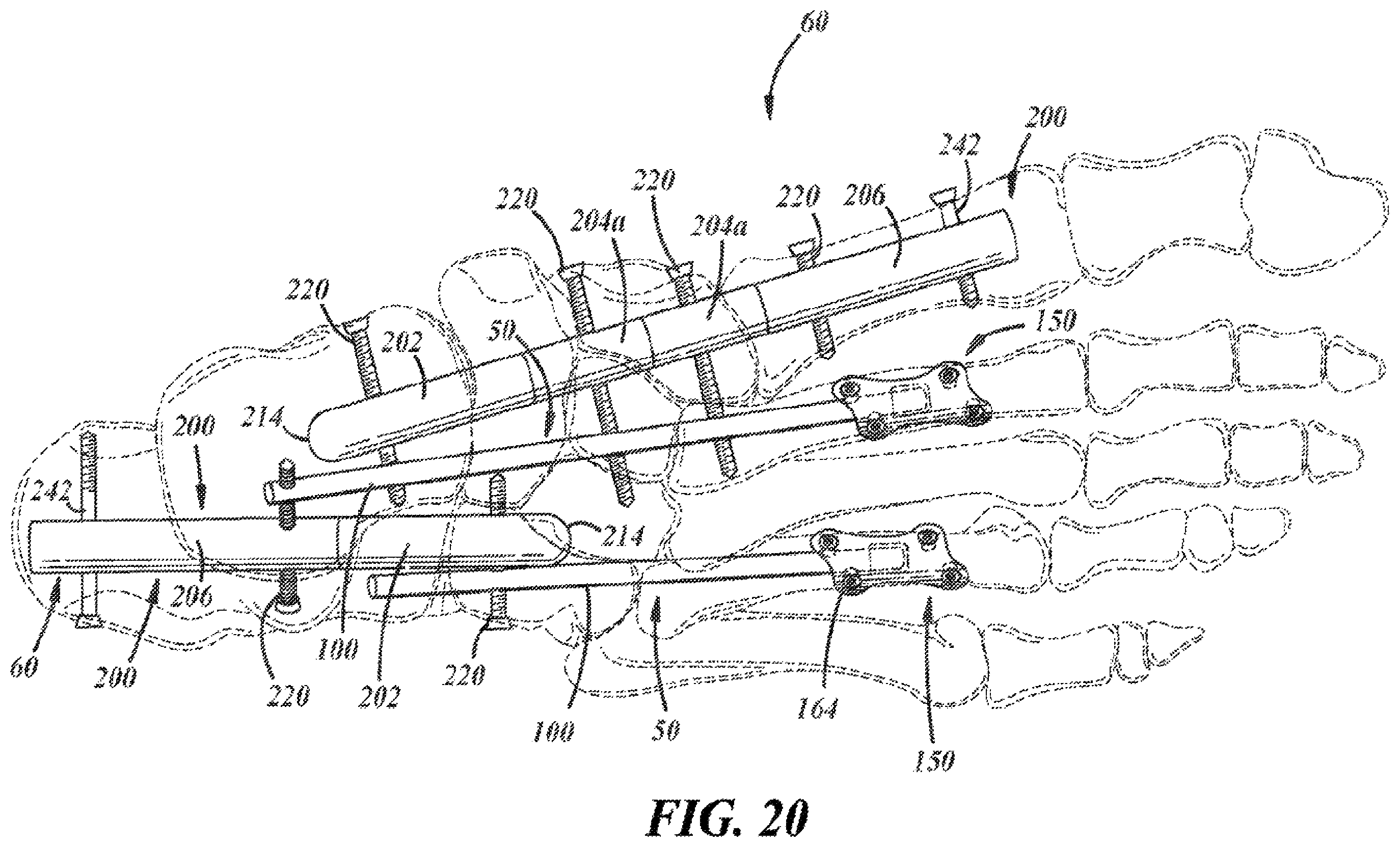 Patent US12396757 Figure 12 – Implants and methods for treating Charcot foot and other conditions