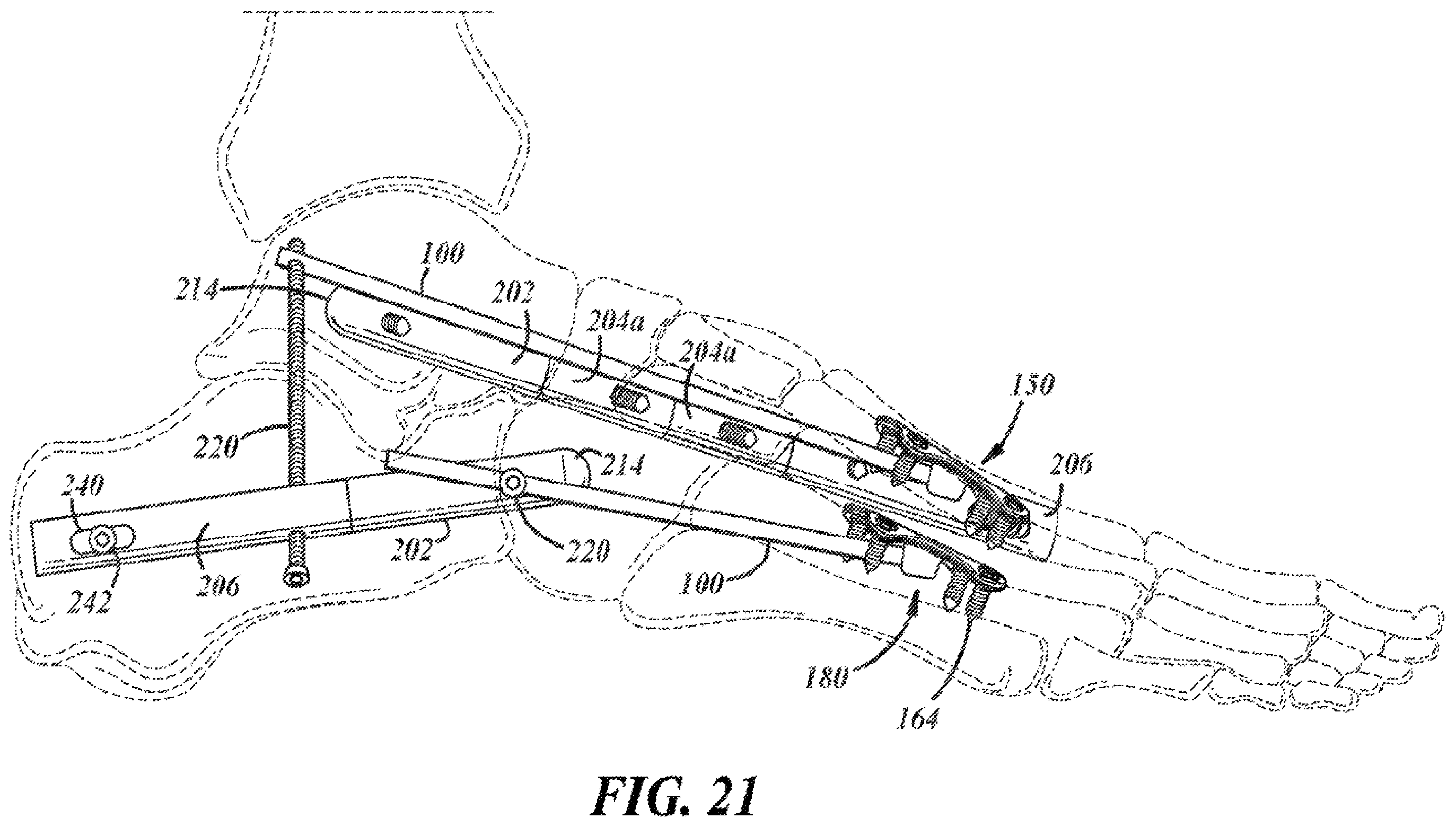 Patent US12396757 Figure 13 – Implants and methods for treating Charcot foot and other conditions