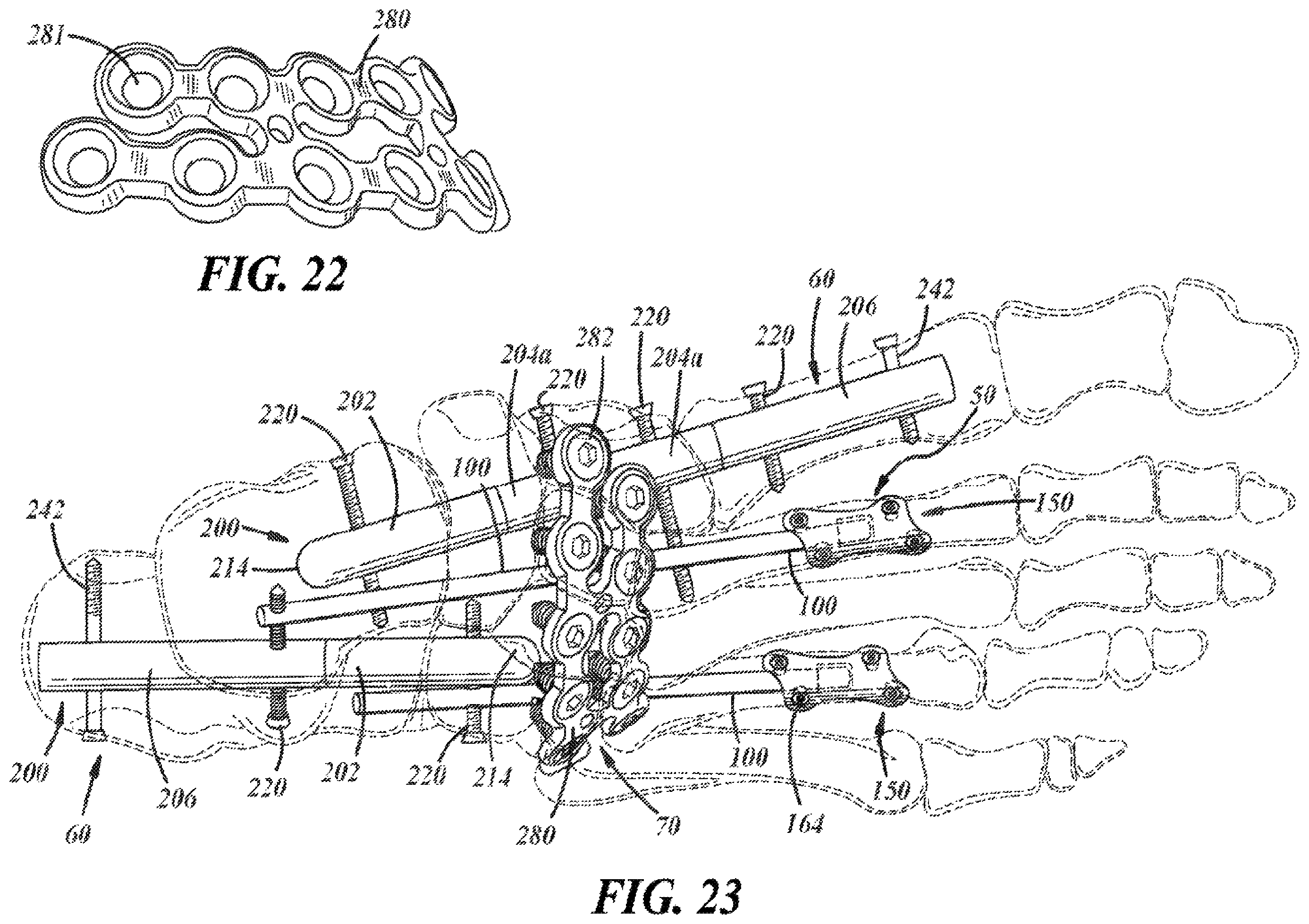 Patent US12396757 Figure 14 – Implants and methods for treating Charcot foot and other conditions